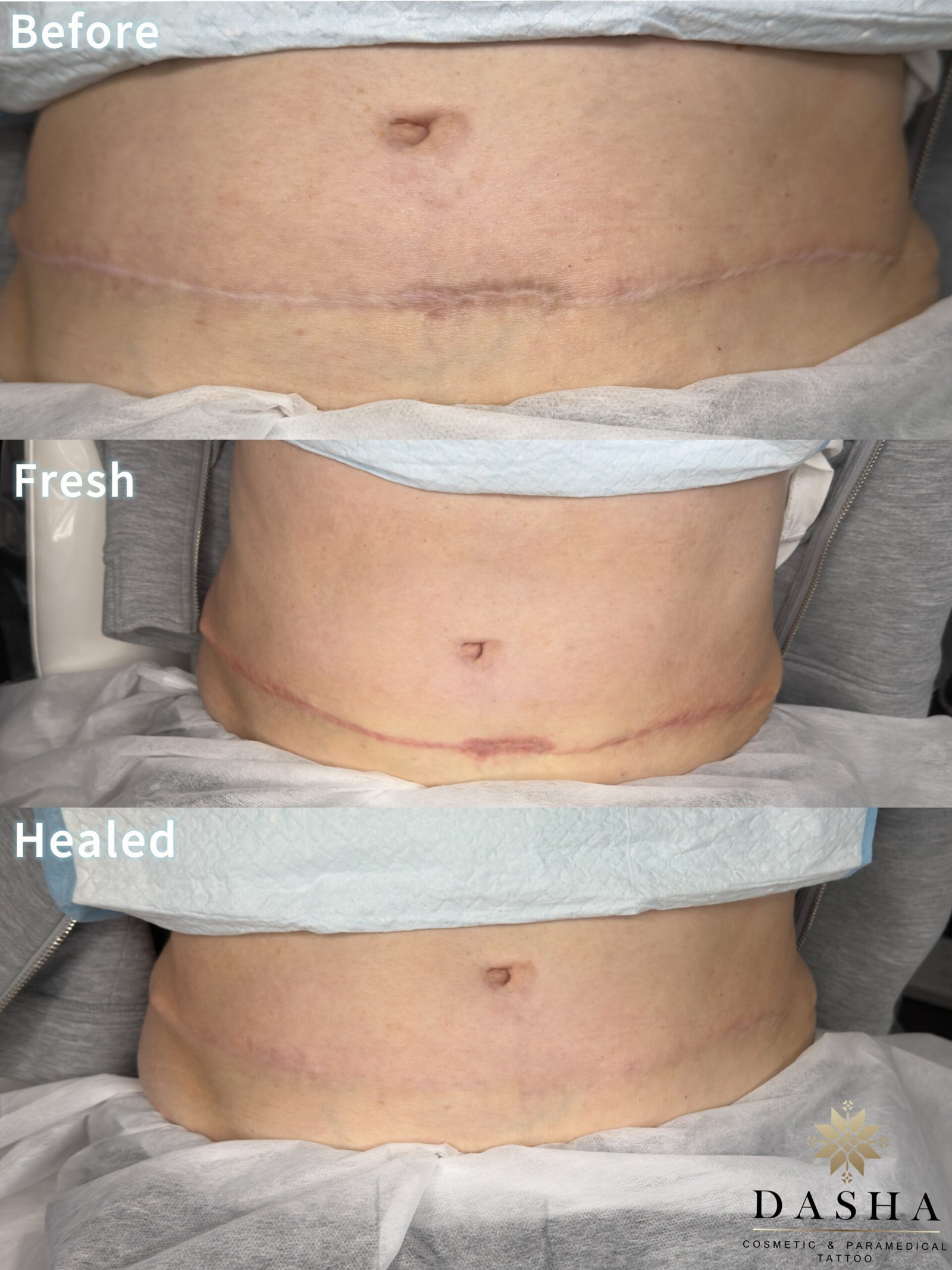 Tummy Tuck Camouflahe. Cosmetic and Mediical Tattoo by Dasha. Permanent makeup and reconstructive tattoo, scalp micro-pigmentation in Christchurch, New Zealand