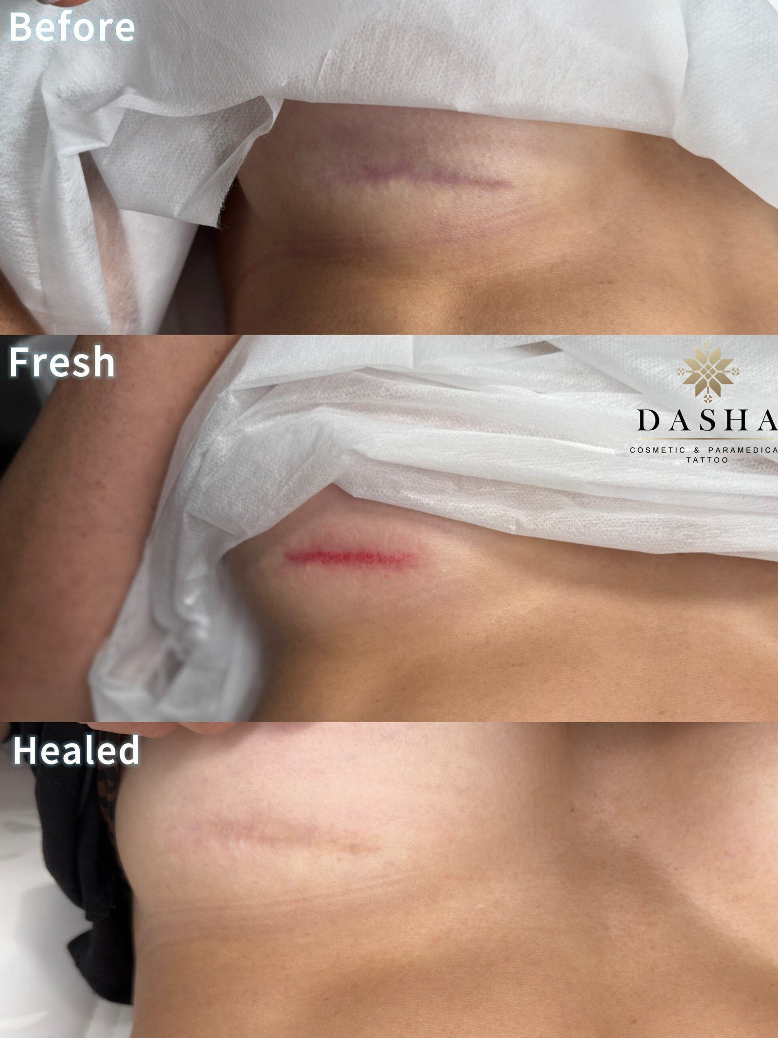 Inframammary fold incision scar Camouflage. Cosmetic and Mediical Tattoo by Dasha. Permanent makeup and reconstructive tattoo, scalp micro-pigmentation in Christchurch, New Zealand