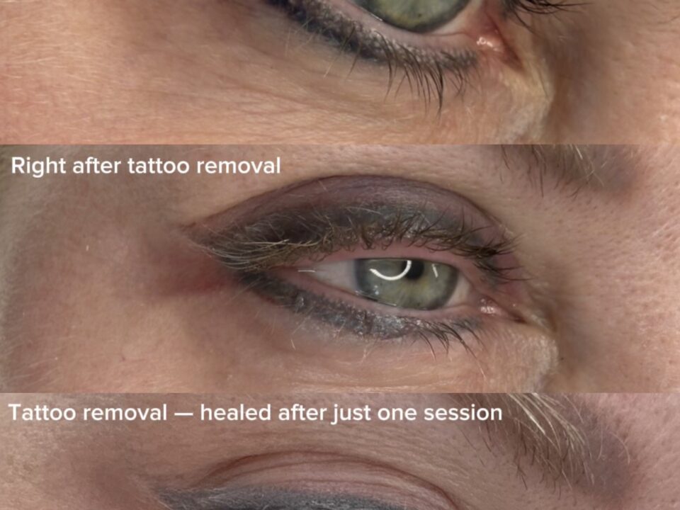 Eyeliner Tattoo Removal. Cosmetic and Mediical Tattoo by Dasha. Permanent makeup and reconstructive tattoo, scalp micro-pigmentation in Christchurch, New Zealand