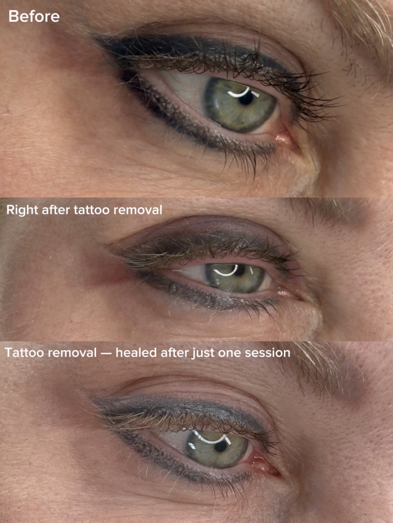 Eyeliner Tattoo Removal