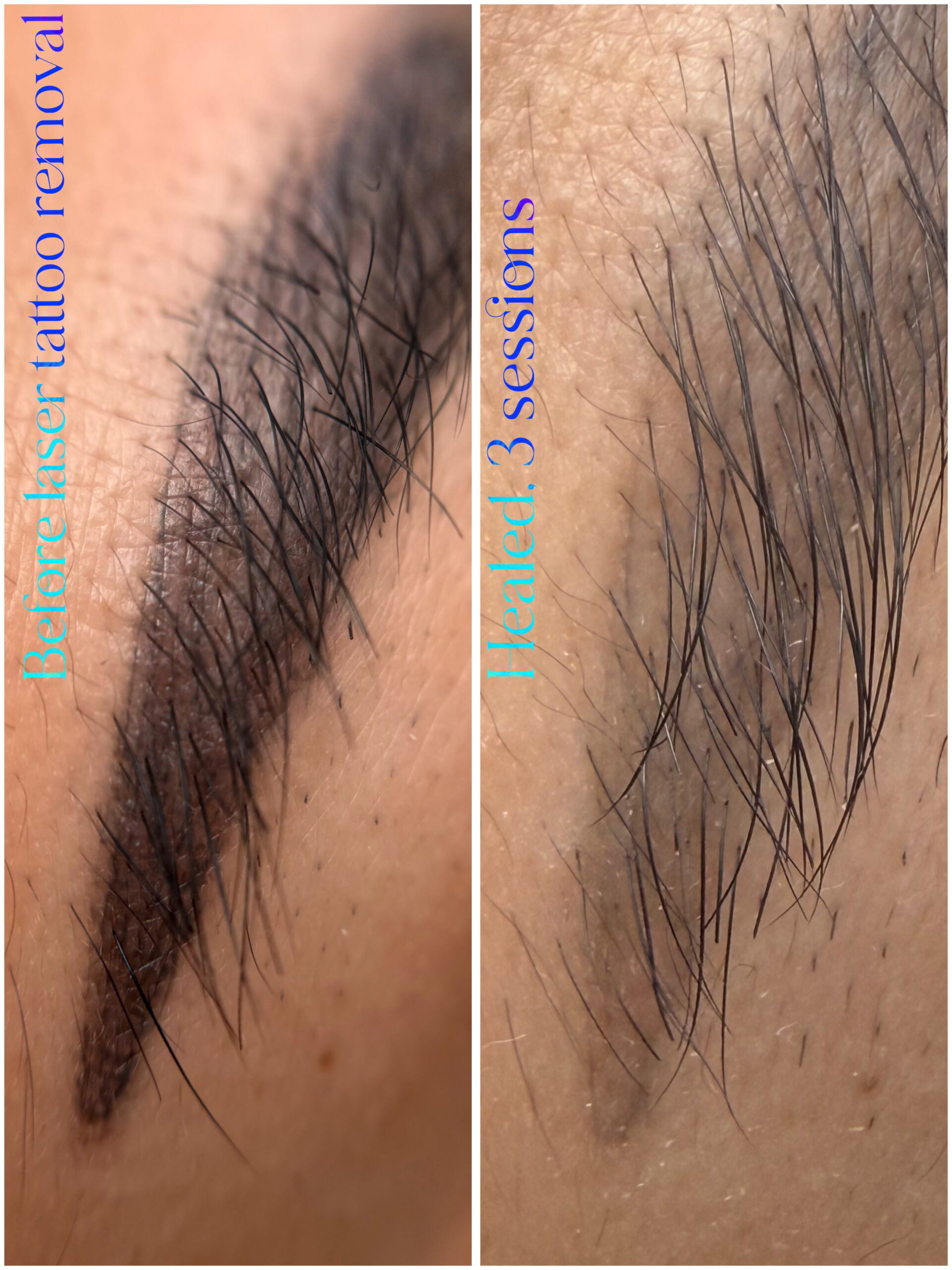 How Many Treatments Do I Need For Laser Tattoo Removal?. Cosmetic and Mediical Tattoo by Dasha. Permanent makeup and reconstructive tattoo, scalp micro-pigmentation in Christchurch, New Zealand