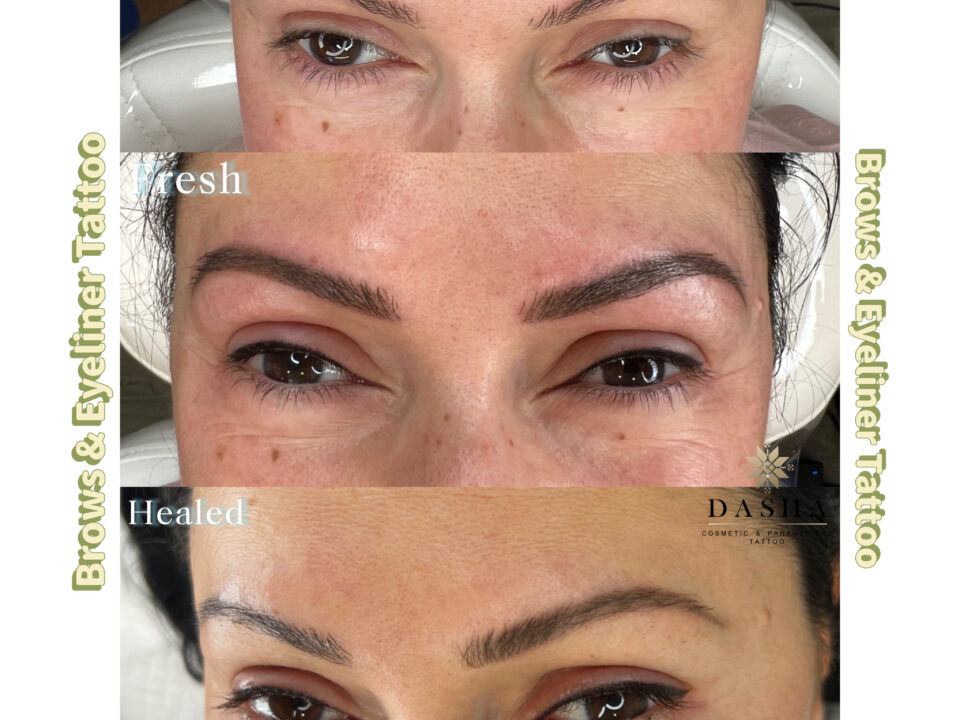 Microblading/Brows Tattoo Removal. Cosmetic and Mediical Tattoo by Dasha. Permanent makeup and reconstructive tattoo, scalp micro-pigmentation in Christchurch, New Zealand