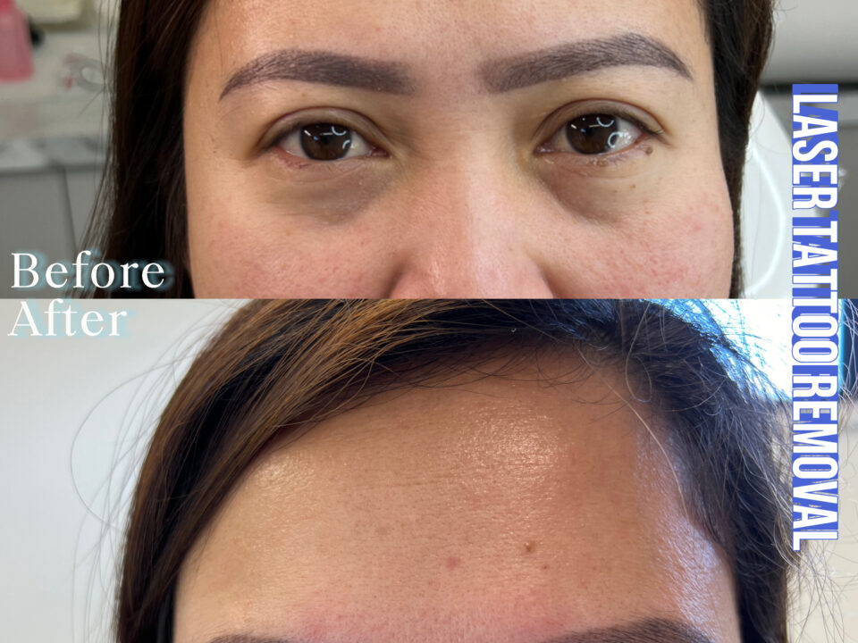 Brows Tattoo Laser Tattoo Removal. Cosmetic and Mediical Tattoo by Dasha. Permanent makeup and reconstructive tattoo, scalp micro-pigmentation in Christchurch, New Zealand