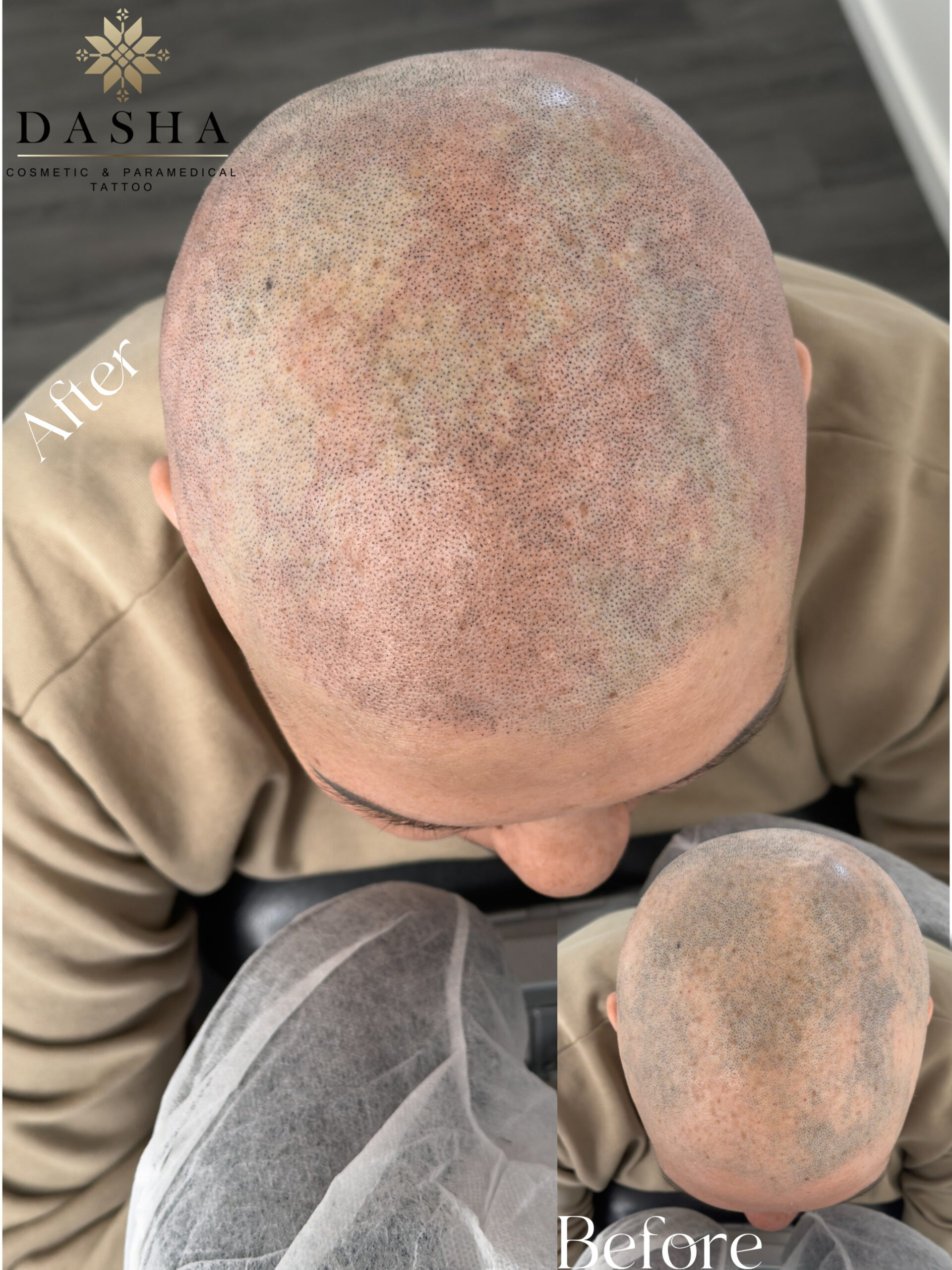 SMP for Alopecia Areata. Cosmetic and Mediical Tattoo by Dasha. Permanent makeup and reconstructive tattoo, scalp micro-pigmentation in Christchurch, New Zealand
