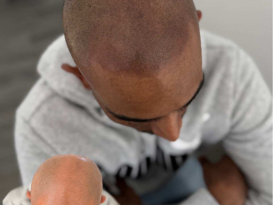 Scalp Micropigmentation for the Hairline and Crown Area. Cosmetic and Mediical Tattoo by Dasha. Permanent makeup and reconstructive tattoo, scalp micro-pigmentation in Christchurch, New Zealand
