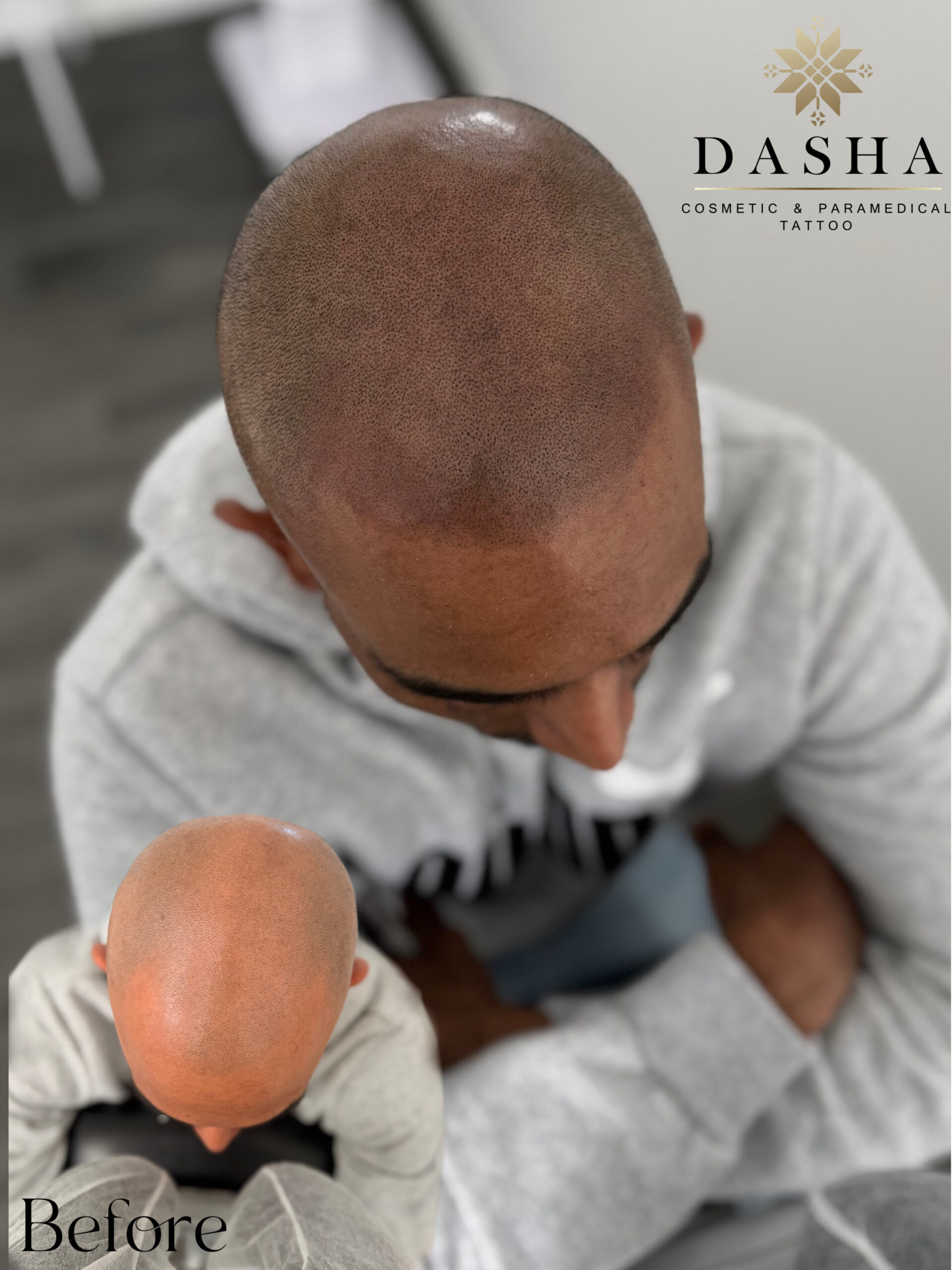 Scalp Micropigmentation for the Hairline and Crown Area. Cosmetic and Mediical Tattoo by Dasha. Permanent makeup and reconstructive tattoo, scalp micro-pigmentation in Christchurch, New Zealand