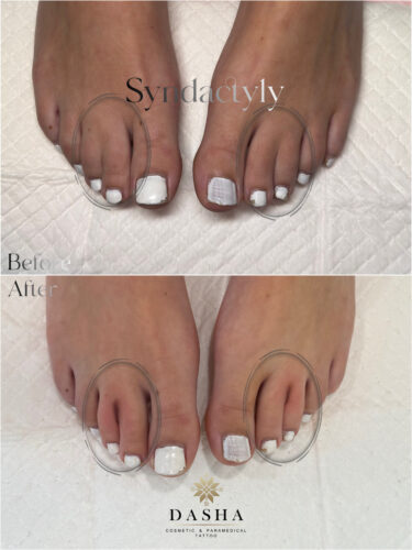 Webbed Toes (Syndactyly) Camouflage Tattoo