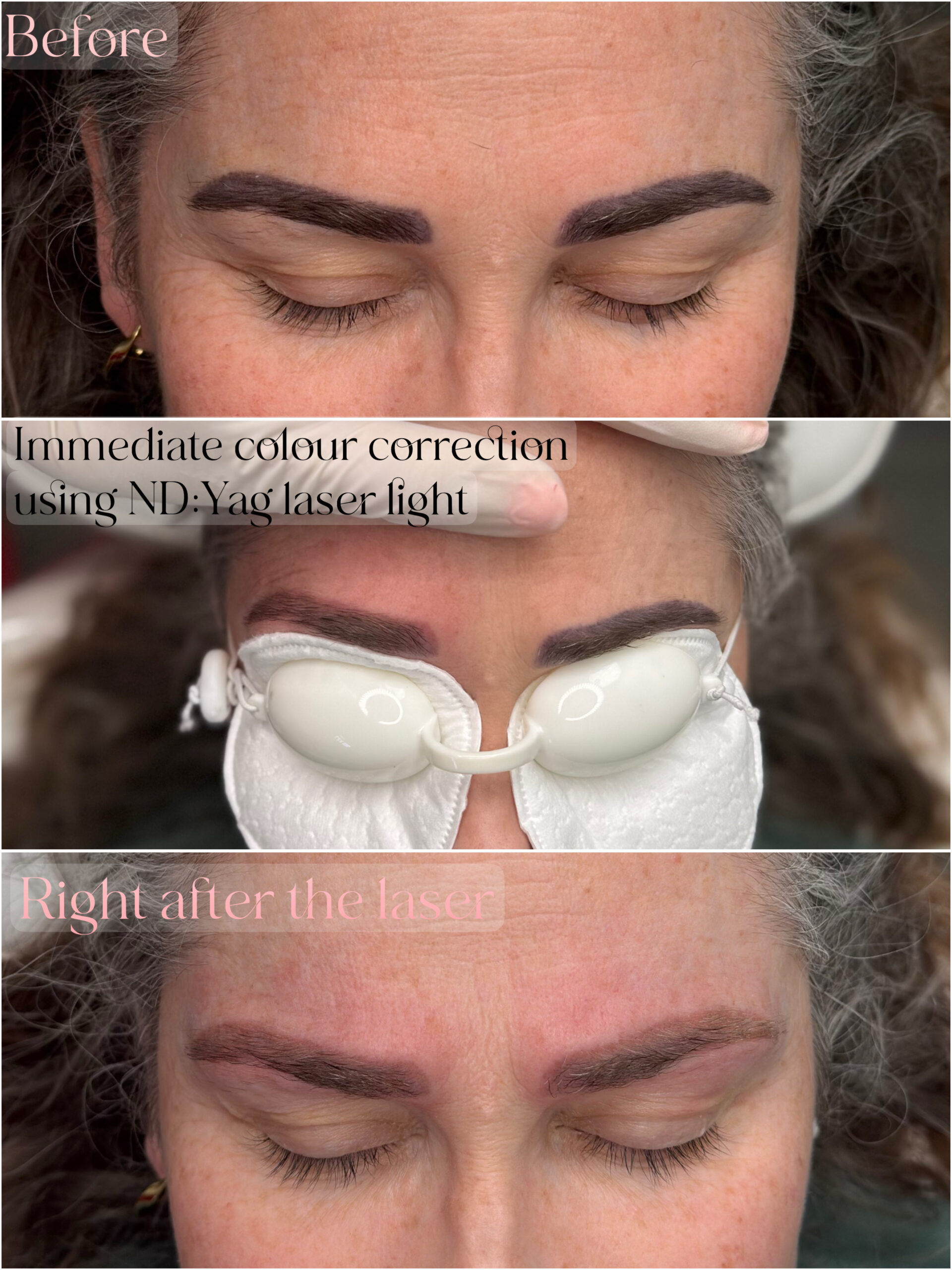 Eyebrow Laser Tattoo Removal. Cosmetic and Mediical Tattoo by Dasha. Permanent makeup and reconstructive tattoo, scalp micro-pigmentation in Christchurch, New Zealand