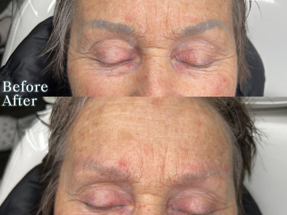 Brows Tattoo Removal. Cosmetic and Mediical Tattoo by Dasha. Permanent makeup and reconstructive tattoo, scalp micro-pigmentation in Christchurch, New Zealand