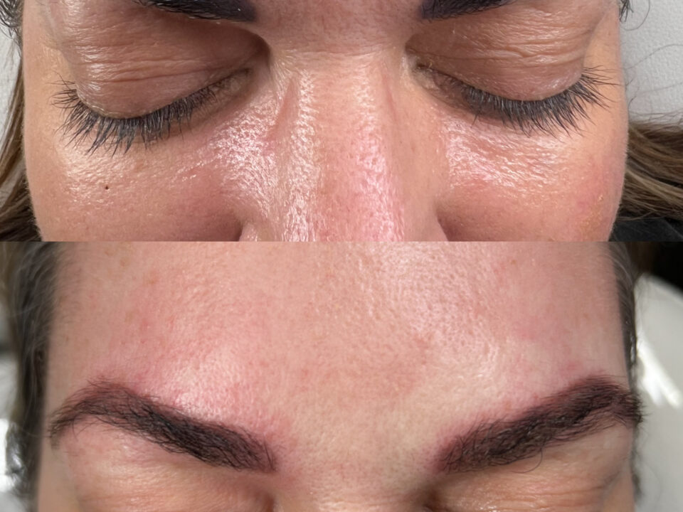 Brows Tattoo Removal. Cosmetic and Mediical Tattoo by Dasha. Permanent makeup and reconstructive tattoo, scalp micro-pigmentation in Christchurch, New Zealand