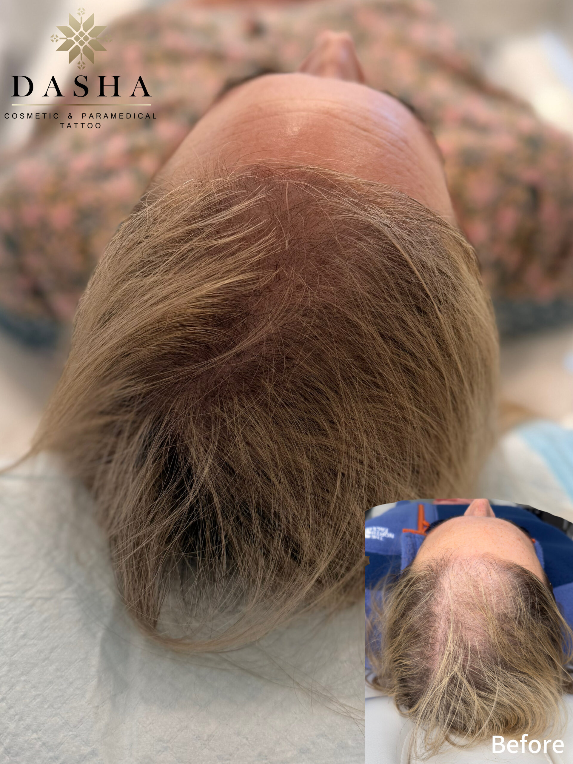 Scalp Micropigmentation for Hair Density. Cosmetic and Mediical Tattoo by Dasha. Permanent makeup and reconstructive tattoo, scalp micro-pigmentation in Christchurch, New Zealand