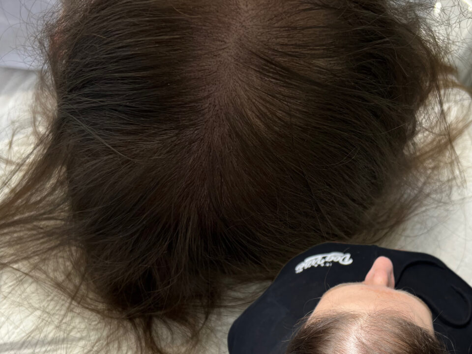 Scalp Micropigmentation for Hair Density. Cosmetic and Mediical Tattoo by Dasha. Permanent makeup and reconstructive tattoo, scalp micro-pigmentation in Christchurch, New Zealand
