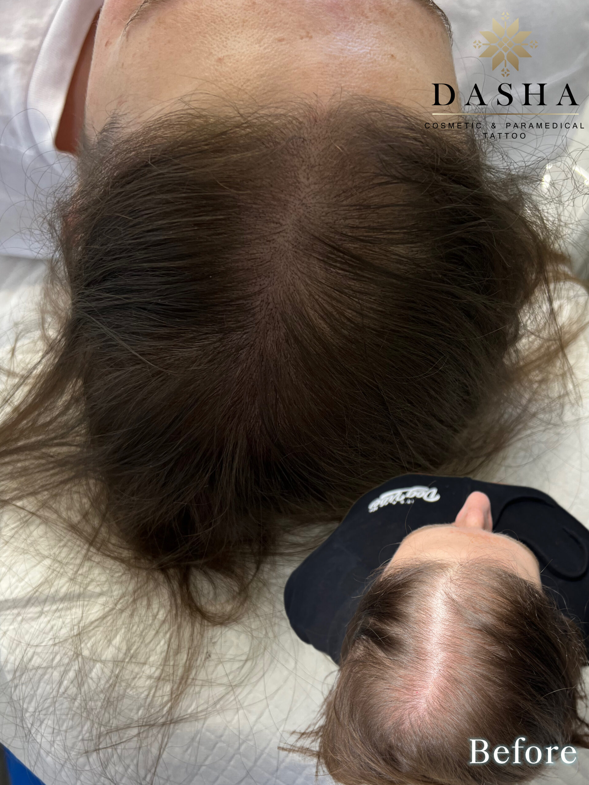 Scalp Micropigmentation for Hair Density. Cosmetic and Mediical Tattoo by Dasha. Permanent makeup and reconstructive tattoo, scalp micro-pigmentation in Christchurch, New Zealand