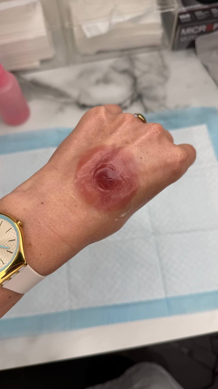 Custom Silicone Nipple & Areola Prosthetics. Cosmetic and Mediical Tattoo by Dasha. Permanent makeup and reconstructive tattoo, scalp micro-pigmentation in Christchurch, New Zealand