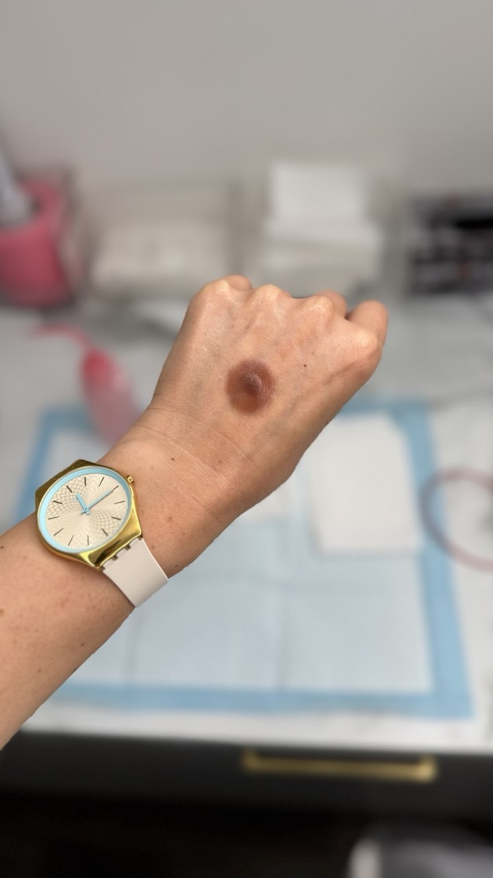 Custom Silicone Nipple & Areola Prosthetics. Cosmetic and Mediical Tattoo by Dasha. Permanent makeup and reconstructive tattoo, scalp micro-pigmentation in Christchurch, New Zealand