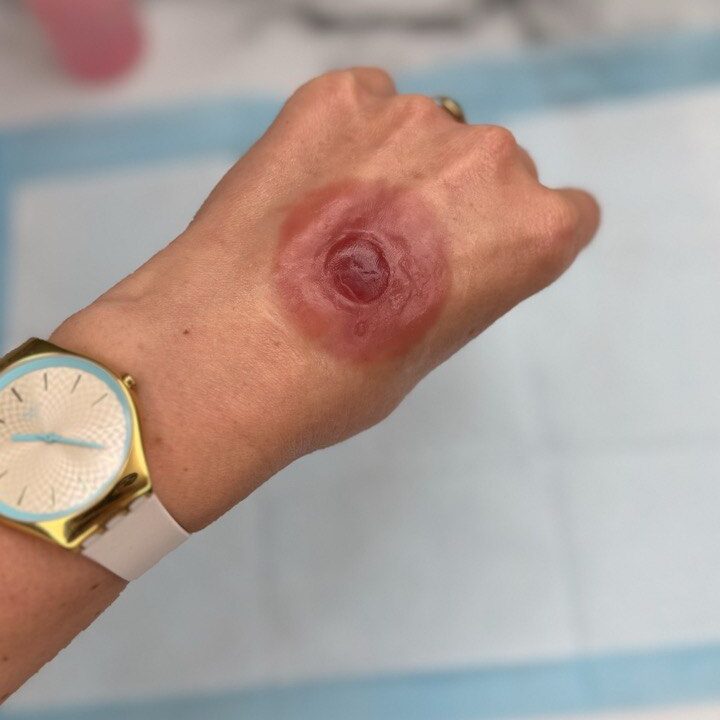 Custom Silicone Nipple & Areola Prosthetics. Cosmetic and Mediical Tattoo by Dasha. Permanent makeup and reconstructive tattoo, scalp micro-pigmentation in Christchurch, New Zealand
