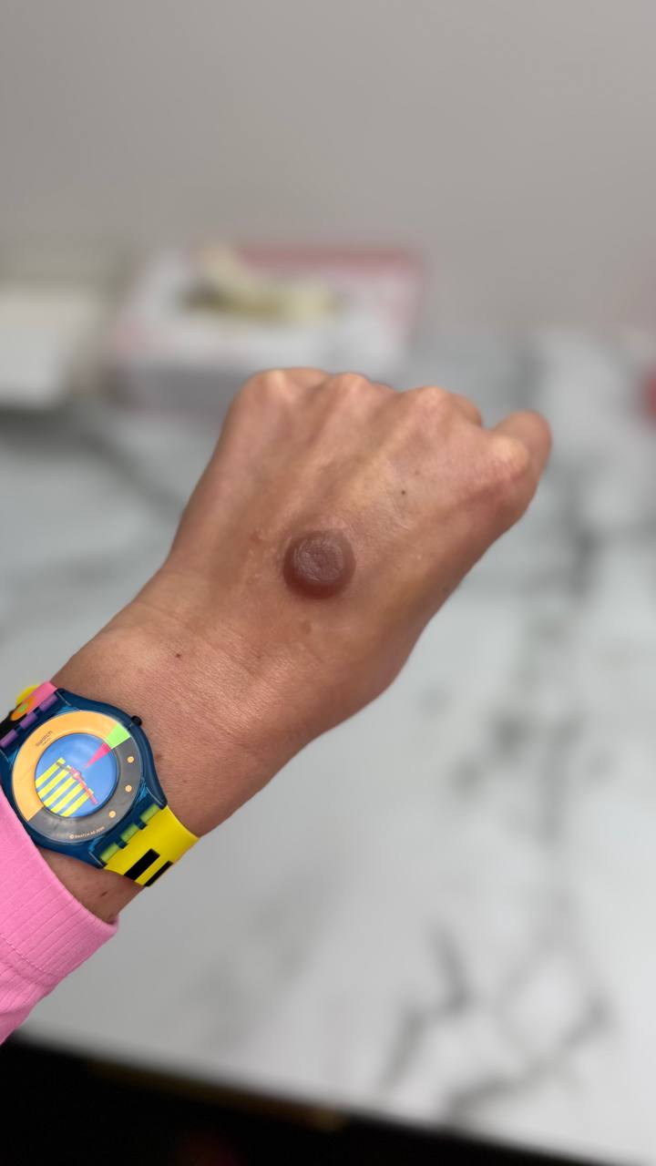 Custom Made Silicone Nipple & Areola Prosthetics. Cosmetic and Mediical Tattoo by Dasha. Permanent makeup and reconstructive tattoo, scalp micro-pigmentation in Christchurch, New Zealand
