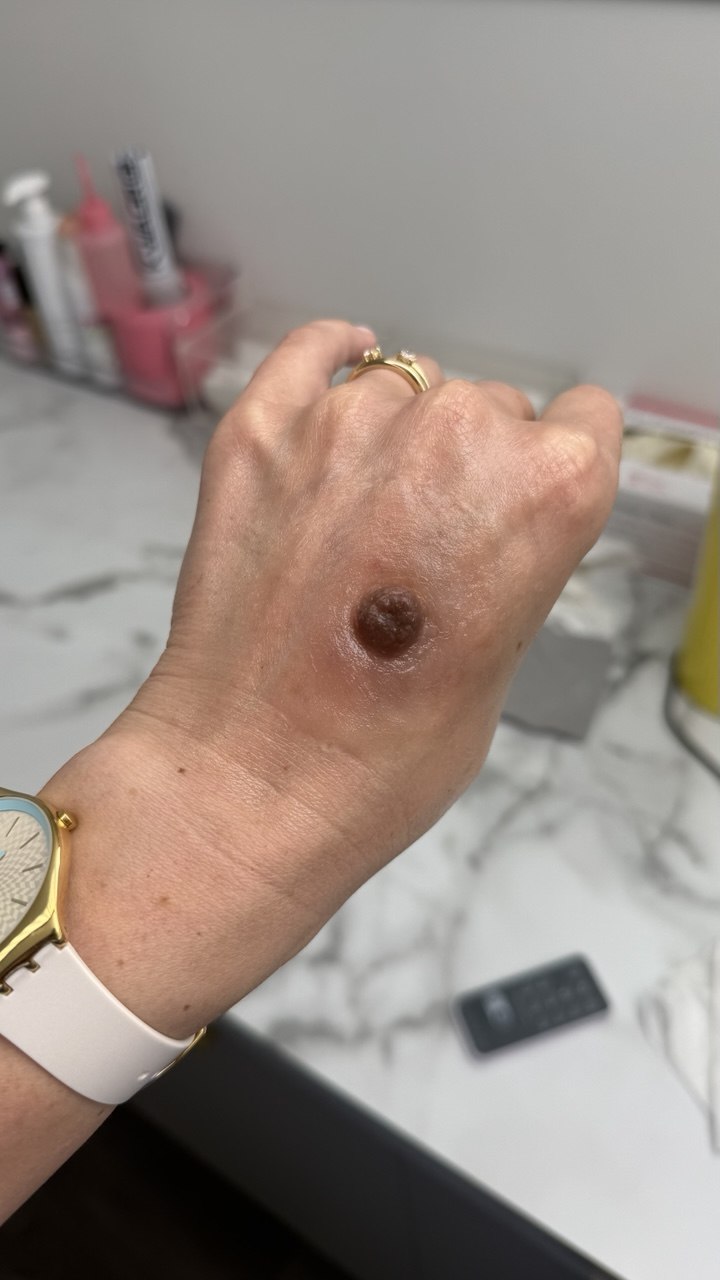 Custom Made Silicone Nipple & Areola Prosthetics. Cosmetic and Mediical Tattoo by Dasha. Permanent makeup and reconstructive tattoo, scalp micro-pigmentation in Christchurch, New Zealand