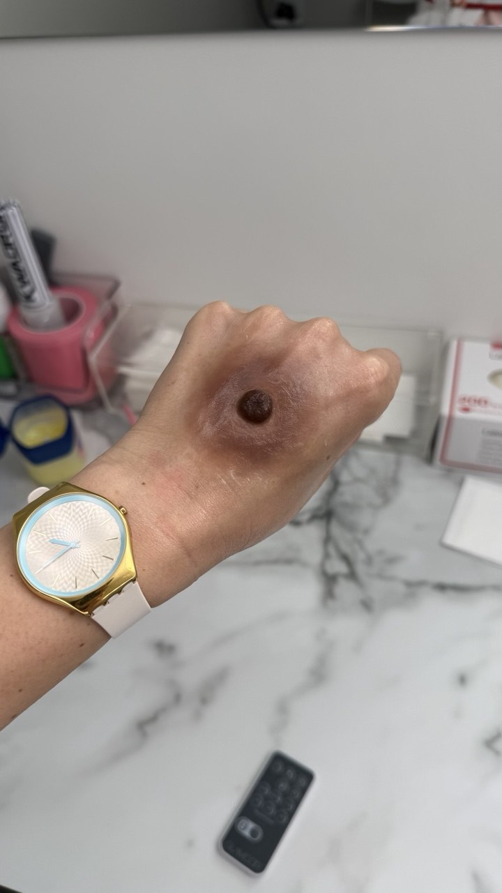 Custom Made Silicone Nipple & Areola Prosthetics. Cosmetic and Mediical Tattoo by Dasha. Permanent makeup and reconstructive tattoo, scalp micro-pigmentation in Christchurch, New Zealand