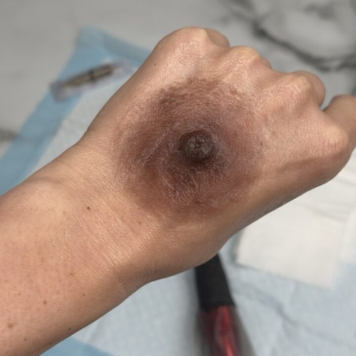 Custom Silicone Nipple & Areola Prosthetics. Cosmetic and Mediical Tattoo by Dasha. Permanent makeup and reconstructive tattoo, scalp micro-pigmentation in Christchurch, New Zealand