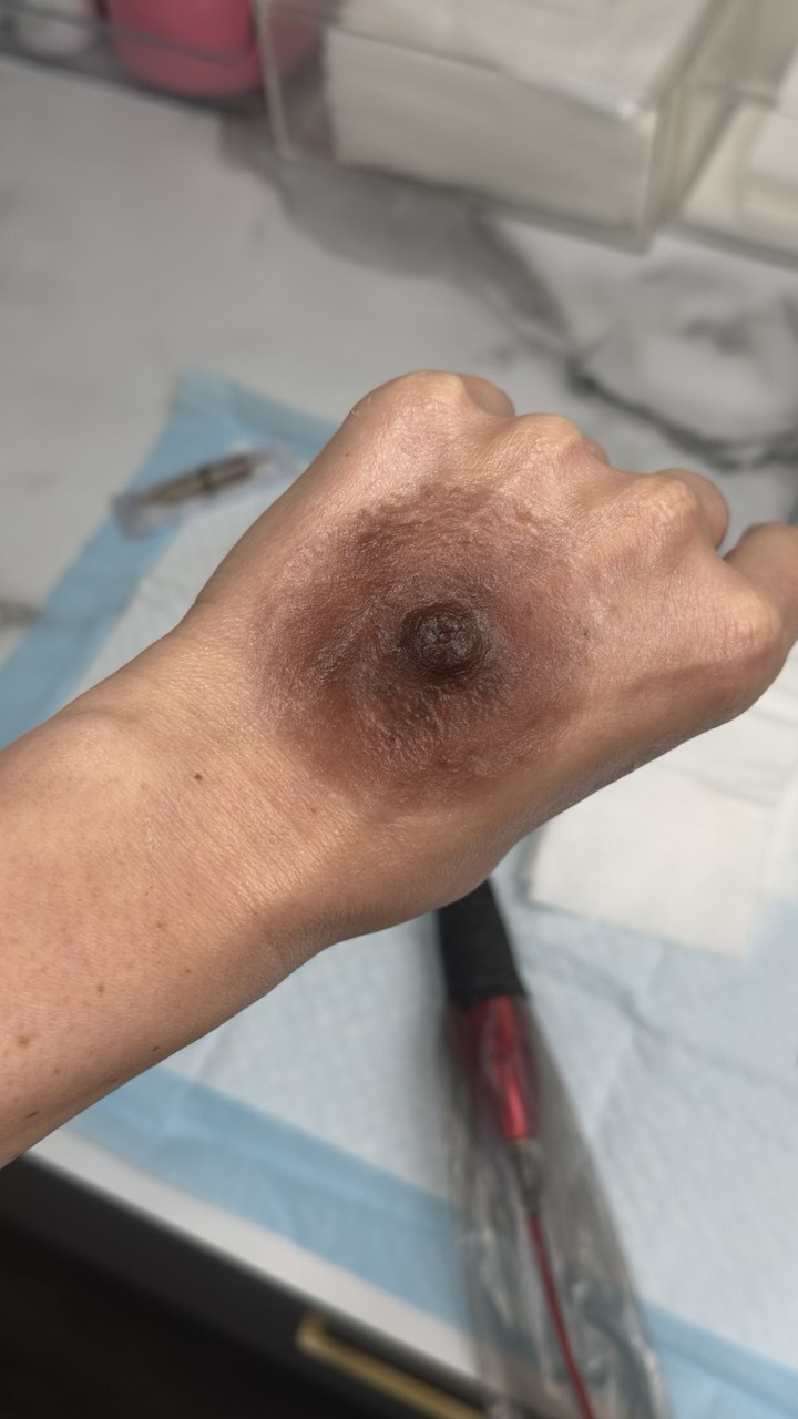 Custom Silicone Nipple & Areola Prosthetics. Cosmetic and Mediical Tattoo by Dasha. Permanent makeup and reconstructive tattoo, scalp micro-pigmentation in Christchurch, New Zealand