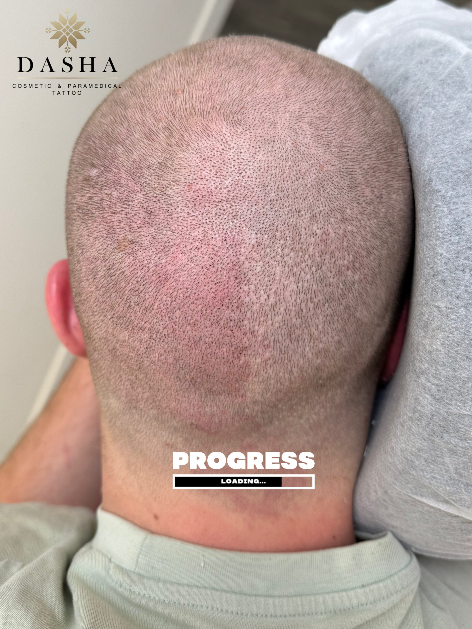 FUE Hair Transplant Scar Camouflage with SMP. Cosmetic and Medical Tattoo by Dasha. Permanent makeup and reconstructive tattoo, scalp micro-pigmentation in Christchurch, New Zealand
