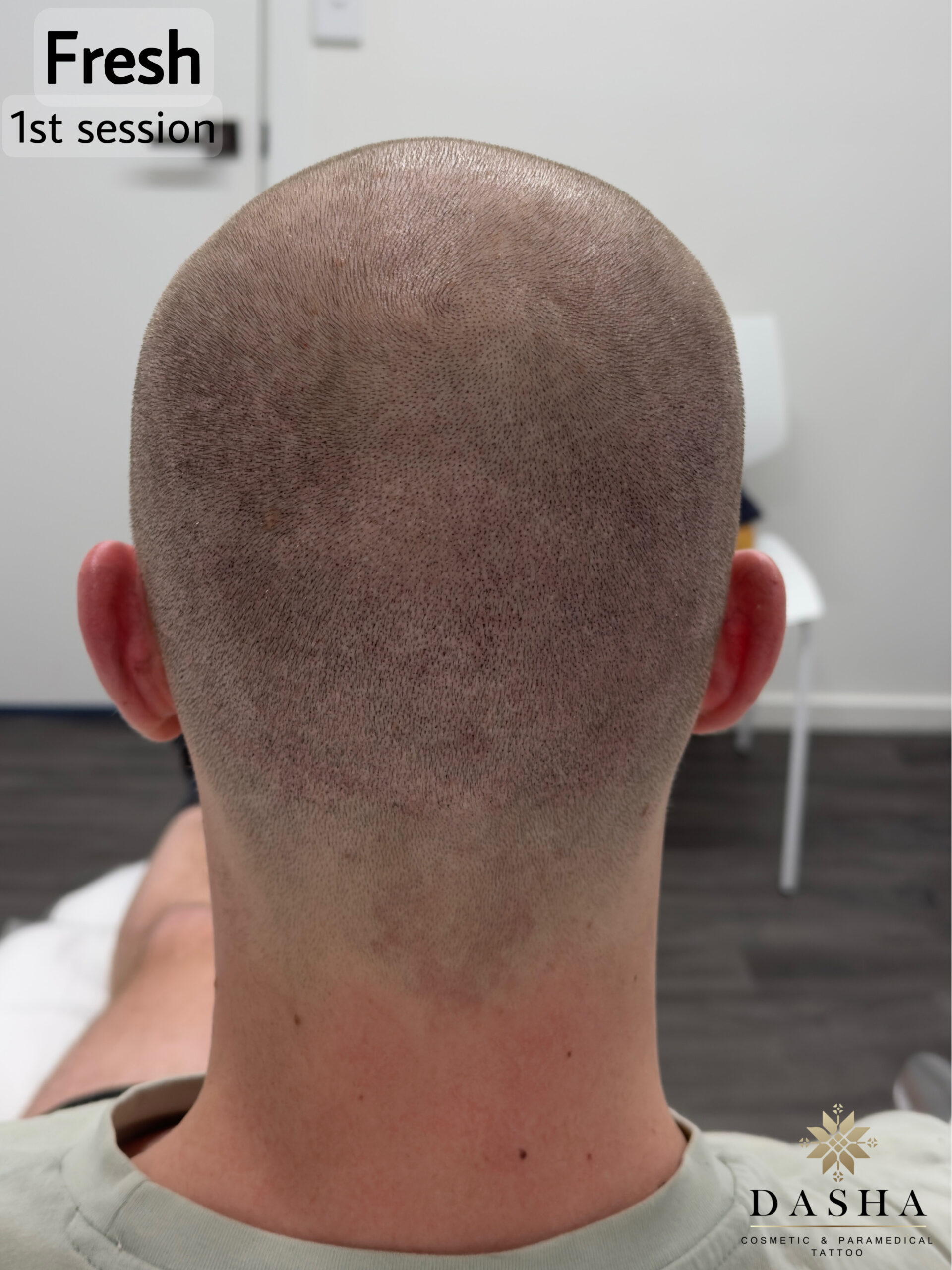 FUE Hair Transplant Scar Camouflage with SMP. Cosmetic and Medical Tattoo by Dasha. Permanent makeup and reconstructive tattoo, scalp micro-pigmentation in Christchurch, New Zealand