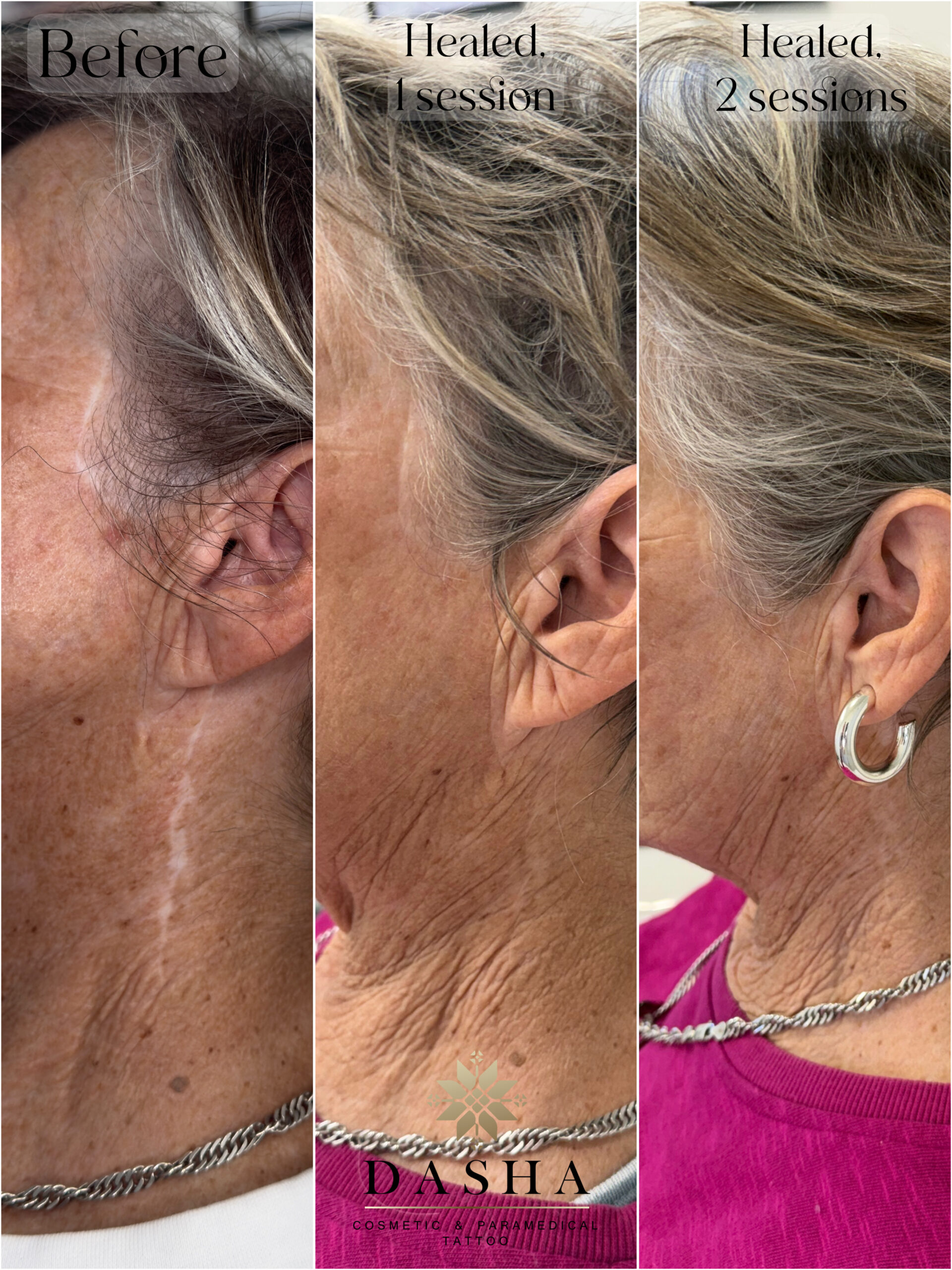 Plastic Surgery Scar Camouflage. Cosmetic and Medical Tattoo by Dasha. Permanent makeup and reconstructive tattoo, scalp micro-pigmentation in Christchurch, New Zealand