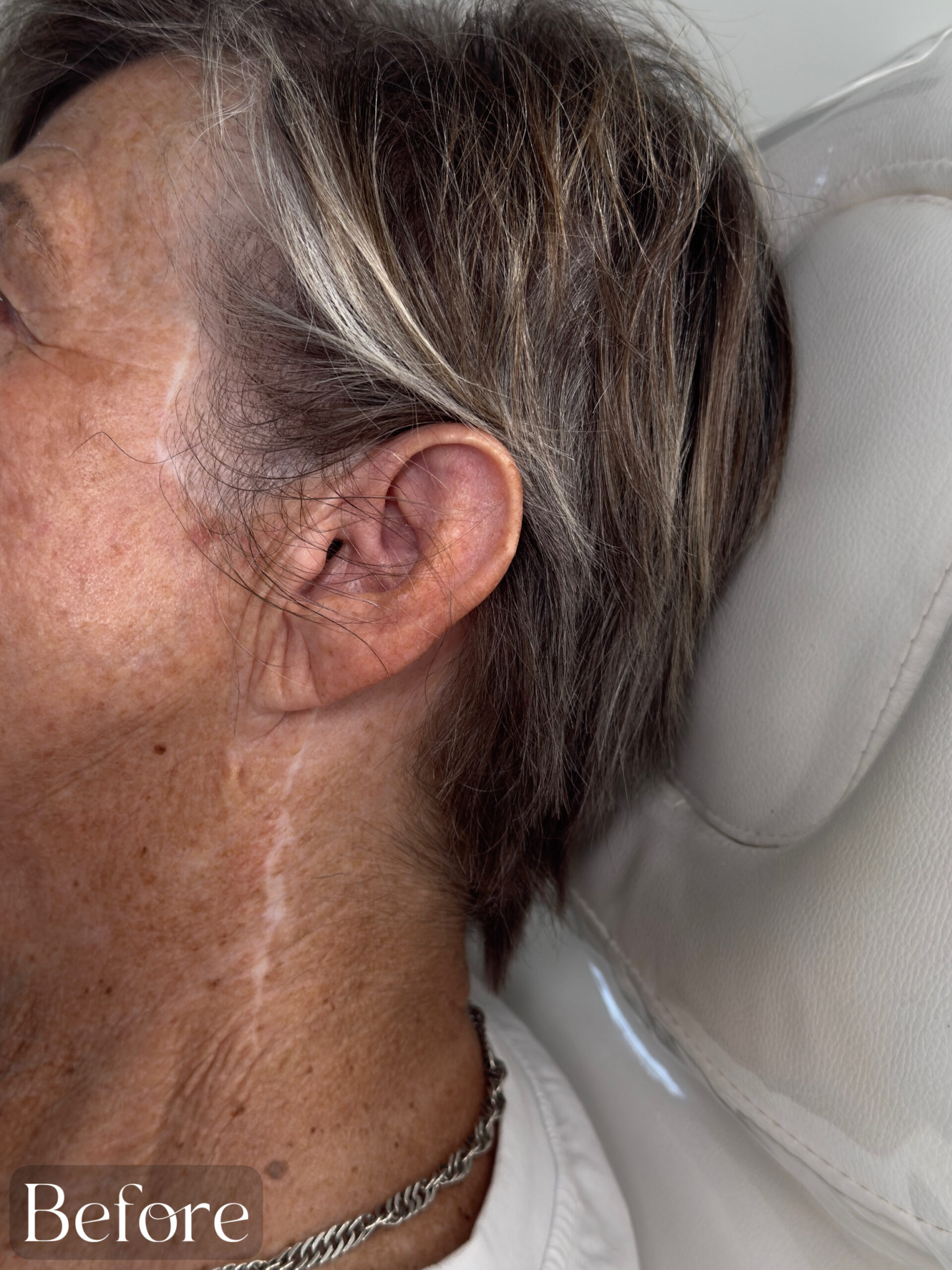 Plastic Surgery Scar Camouflage. Cosmetic and Medical Tattoo by Dasha. Permanent makeup and reconstructive tattoo, scalp micro-pigmentation in Christchurch, New Zealand