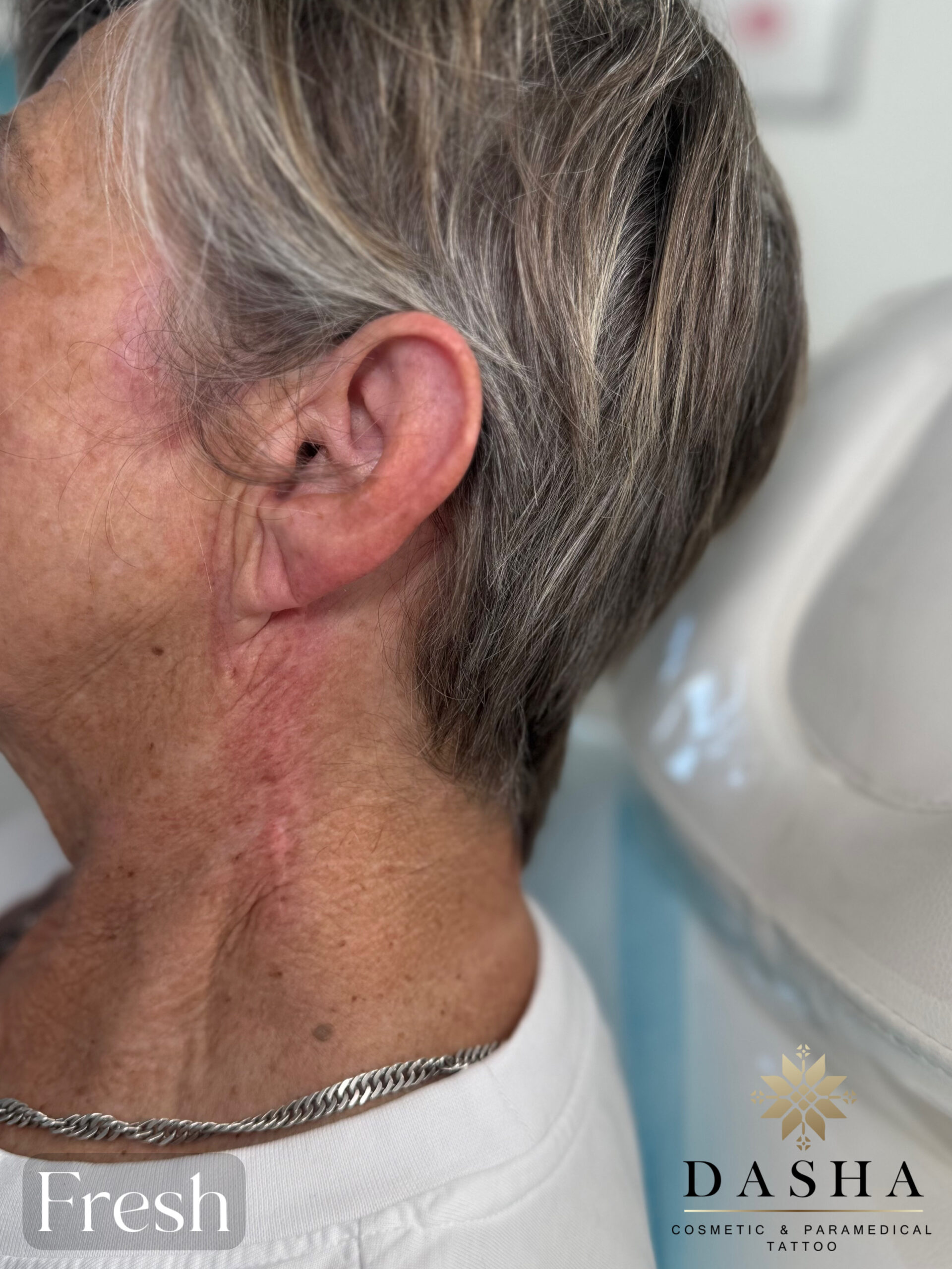 Plastic Surgery Scar Camouflage. Cosmetic and Medical Tattoo by Dasha. Permanent makeup and reconstructive tattoo, scalp micro-pigmentation in Christchurch, New Zealand