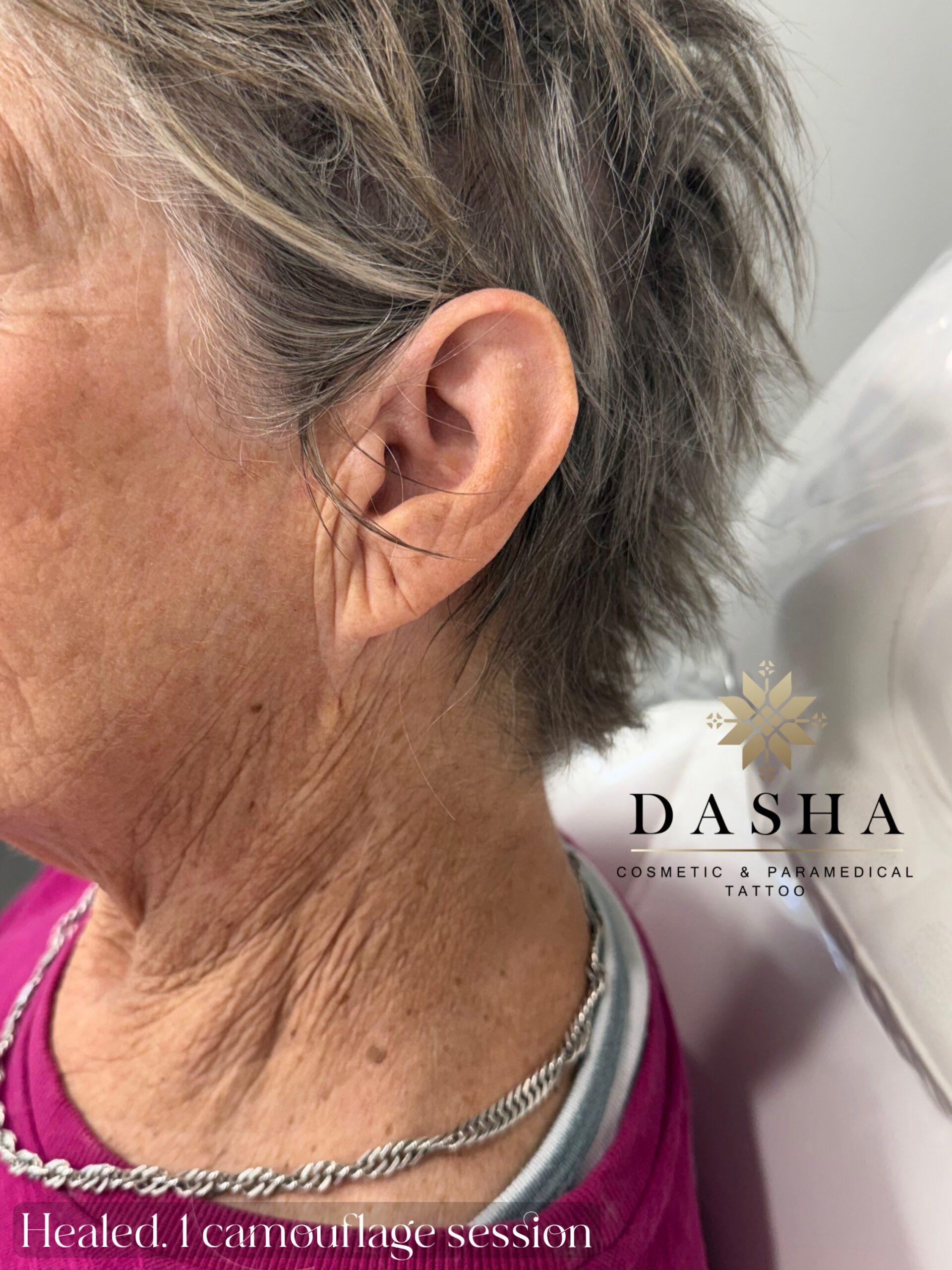 Plastic Surgery Scar Camouflage. Cosmetic and Medical Tattoo by Dasha. Permanent makeup and reconstructive tattoo, scalp micro-pigmentation in Christchurch, New Zealand