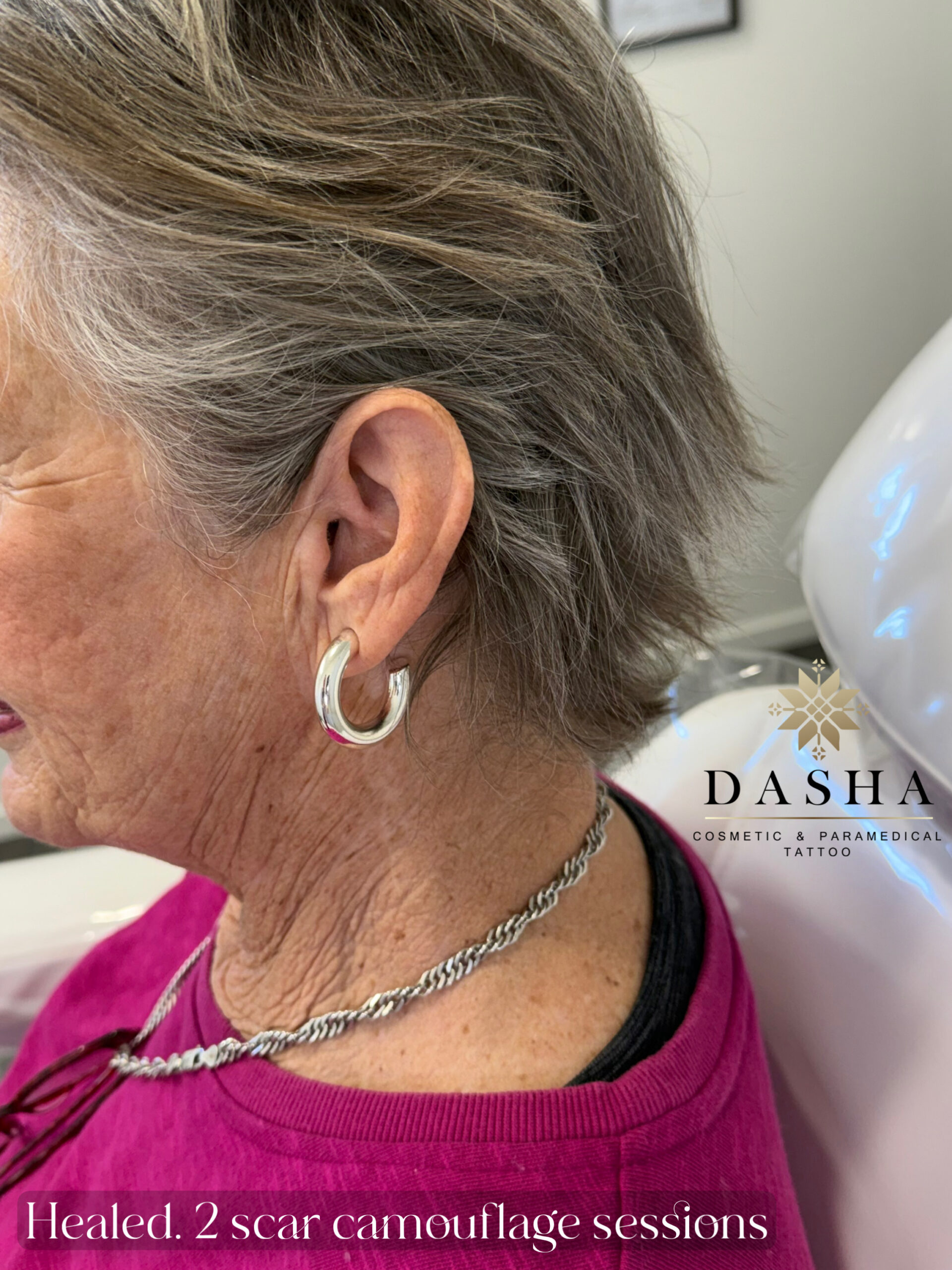 Plastic Surgery Scar Camouflage. Cosmetic and Medical Tattoo by Dasha. Permanent makeup and reconstructive tattoo, scalp micro-pigmentation in Christchurch, New Zealand