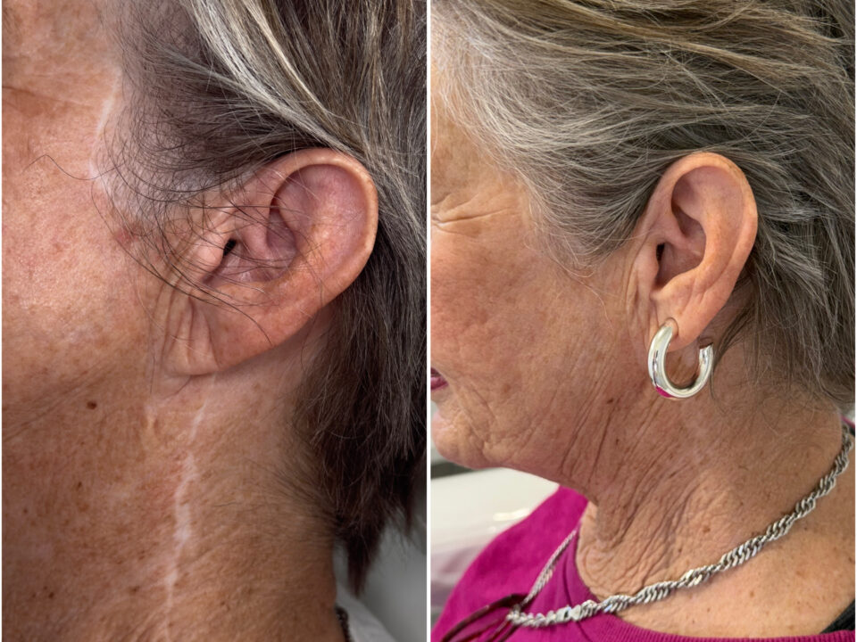Plastic Surgery Scar Camouflage. Cosmetic and Medical Tattoo by Dasha. Permanent makeup and reconstructive tattoo, scalp micro-pigmentation in Christchurch, New Zealand