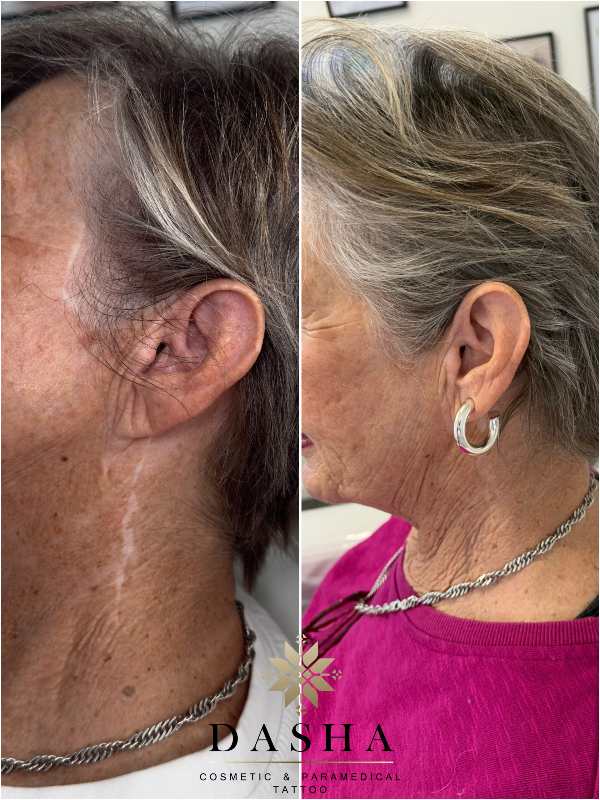 Plastic Surgery Scar Camouflage. Cosmetic and Medical Tattoo by Dasha. Permanent makeup and reconstructive tattoo, scalp micro-pigmentation in Christchurch, New Zealand