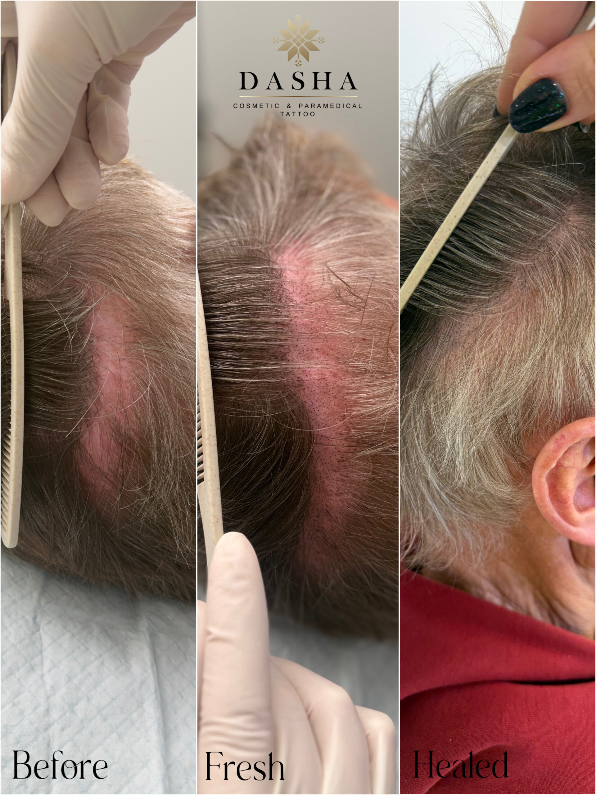 FUT Hair Transplant Scar Camouflage with SMP. Cosmetic and Medical Tattoo by Dasha. Permanent makeup and reconstructive tattoo, scalp micro-pigmentation in Christchurch, New Zealand