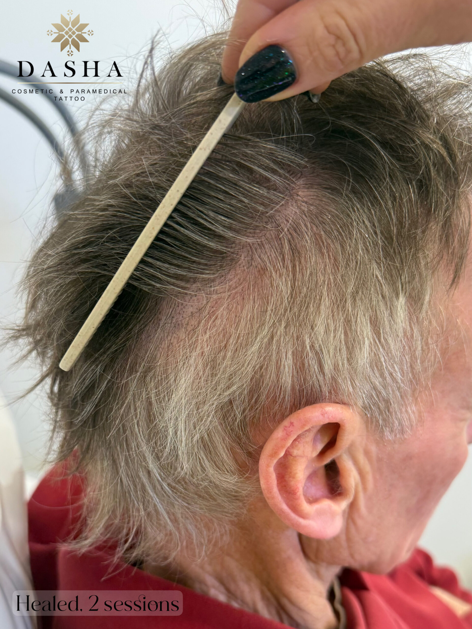 FUT Hair Transplant Scar Camouflage with SMP. Cosmetic and Medical Tattoo by Dasha. Permanent makeup and reconstructive tattoo, scalp micro-pigmentation in Christchurch, New Zealand