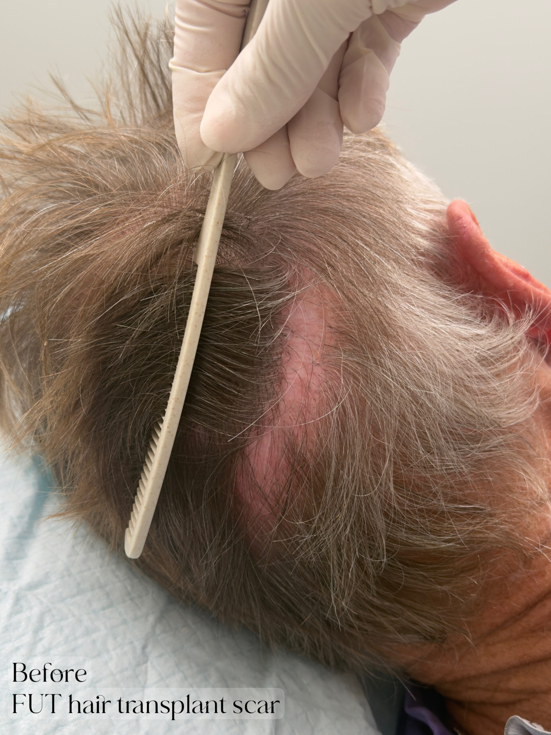 FUT Hair Transplant Scar Camouflage with SMP. Cosmetic and Medical Tattoo by Dasha. Permanent makeup and reconstructive tattoo, scalp micro-pigmentation in Christchurch, New Zealand
