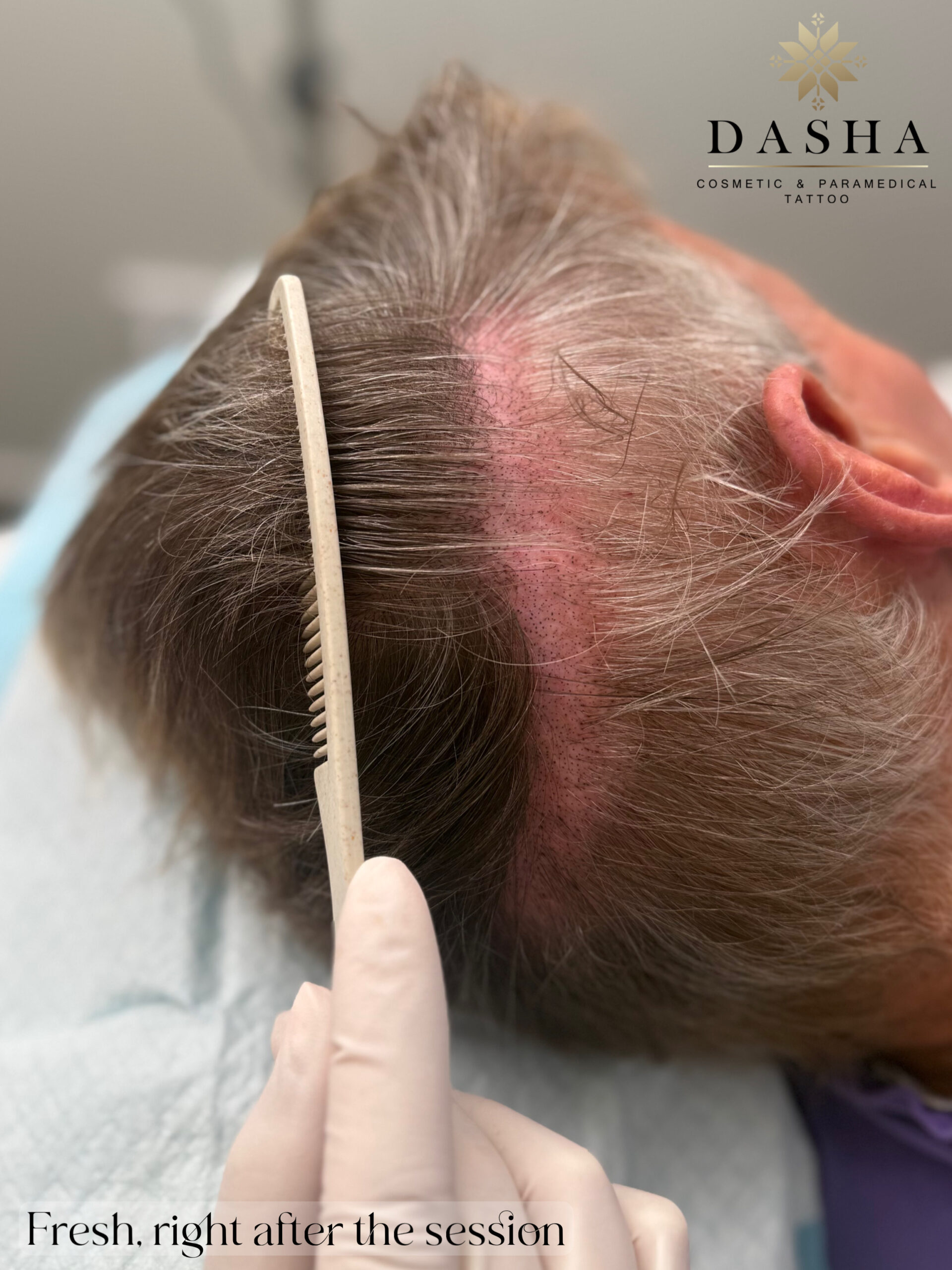 FUT Hair Transplant Scar Camouflage with SMP. Cosmetic and Medical Tattoo by Dasha. Permanent makeup and reconstructive tattoo, scalp micro-pigmentation in Christchurch, New Zealand