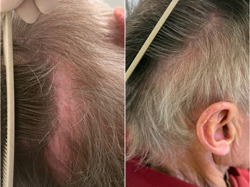 FUT Hair Transplant Scar Camouflage with SMP. Cosmetic and Medical Tattoo by Dasha. Permanent makeup and reconstructive tattoo, scalp micro-pigmentation in Christchurch, New Zealand