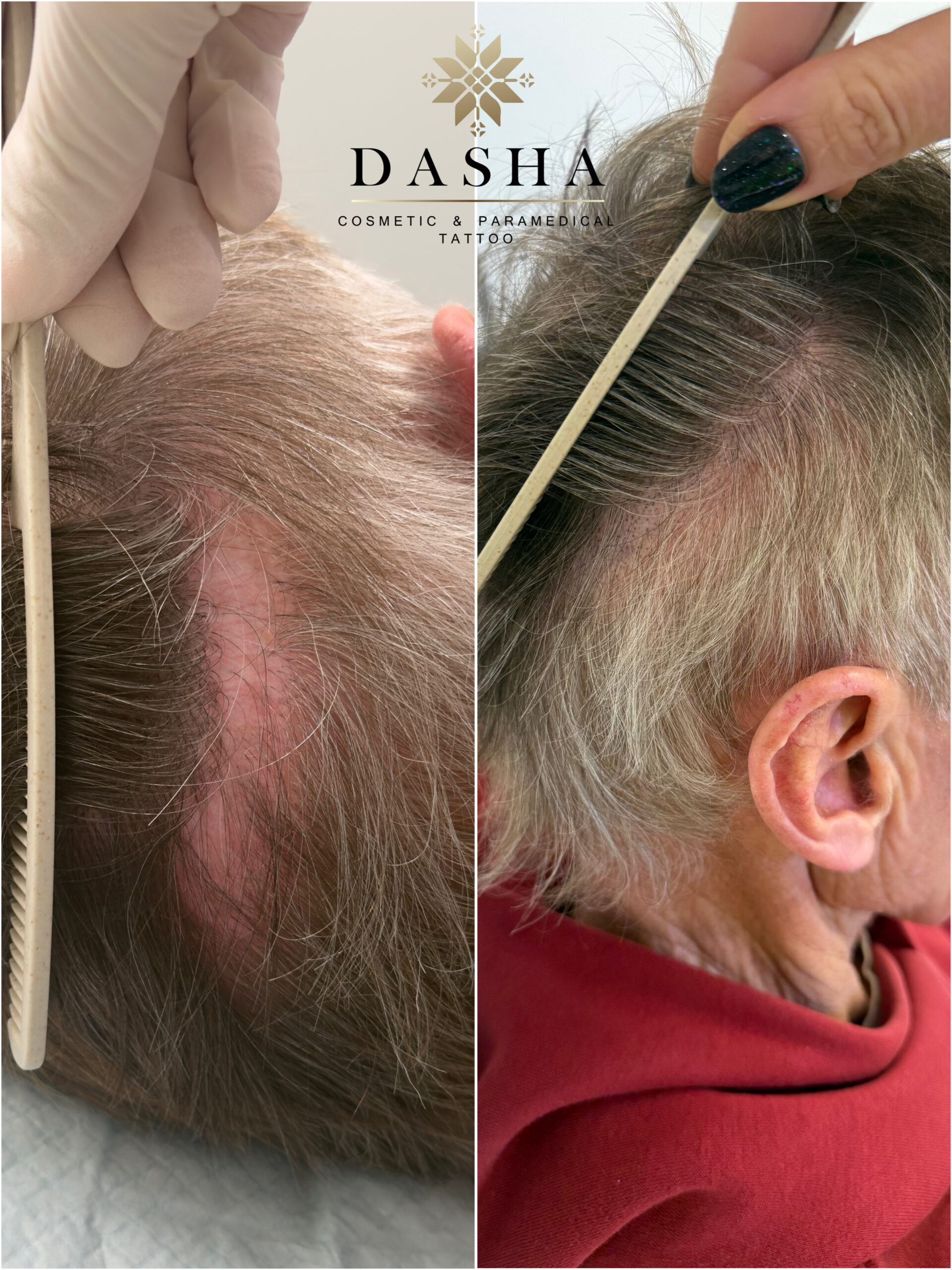FUT Hair Transplant Scar Camouflage with SMP. Cosmetic and Medical Tattoo by Dasha. Permanent makeup and reconstructive tattoo, scalp micro-pigmentation in Christchurch, New Zealand