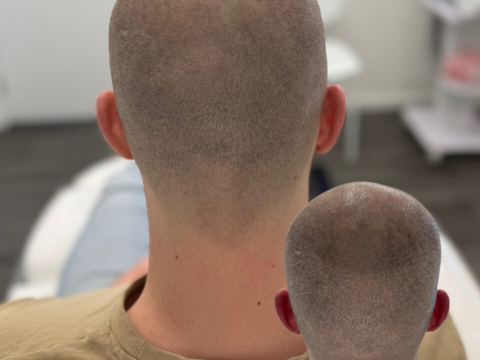FUE Hair Transplant Scar Camouflage with SMP. Cosmetic and Medical Tattoo by Dasha. Permanent makeup and reconstructive tattoo, scalp micro-pigmentation in Christchurch, New Zealand