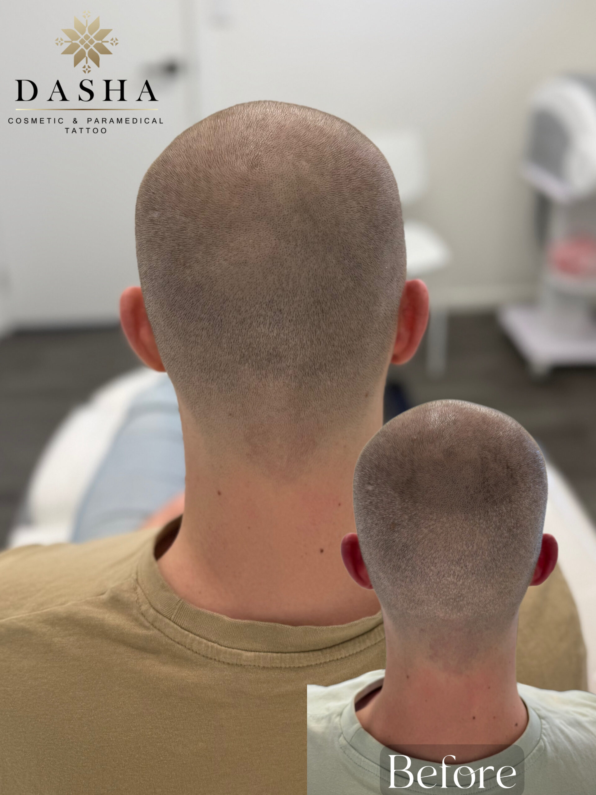 FUE Hair Transplant Scar Camouflage with SMP. Cosmetic and Medical Tattoo by Dasha. Permanent makeup and reconstructive tattoo, scalp micro-pigmentation in Christchurch, New Zealand