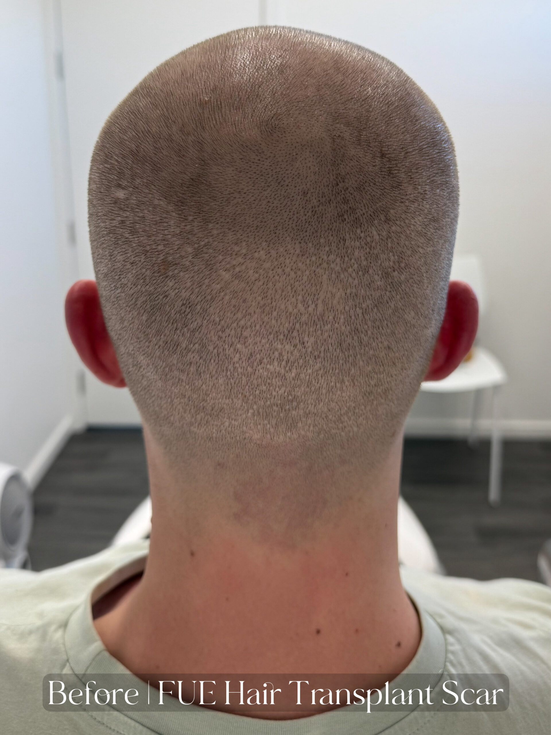FUE Hair Transplant Scar Camouflage with SMP. Cosmetic and Medical Tattoo by Dasha. Permanent makeup and reconstructive tattoo, scalp micro-pigmentation in Christchurch, New Zealand