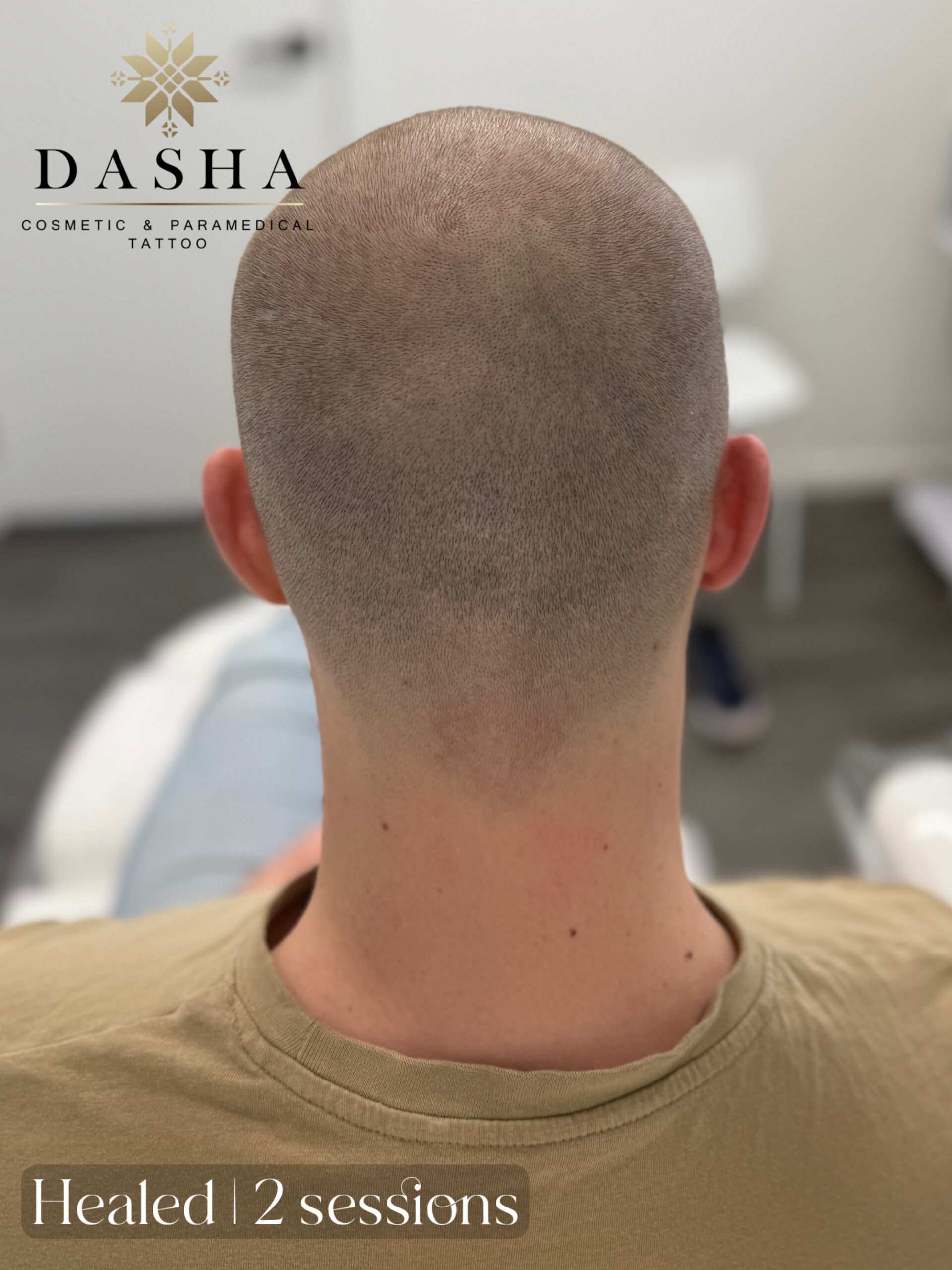 FUE Hair Transplant Scar Camouflage with SMP. Cosmetic and Medical Tattoo by Dasha. Permanent makeup and reconstructive tattoo, scalp micro-pigmentation in Christchurch, New Zealand