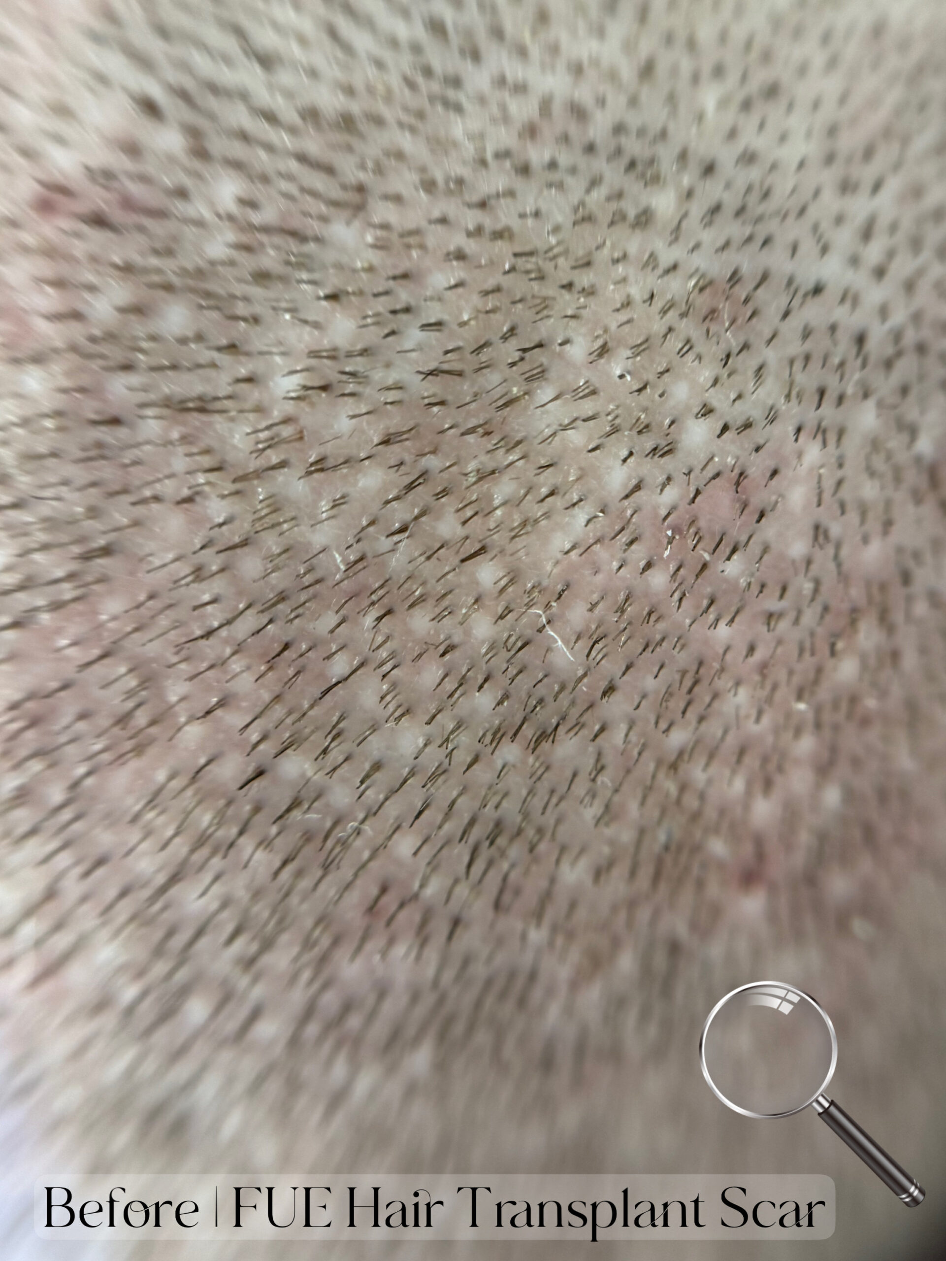 FUE Hair Transplant Scar Camouflage with SMP. Cosmetic and Medical Tattoo by Dasha. Permanent makeup and reconstructive tattoo, scalp micro-pigmentation in Christchurch, New Zealand
