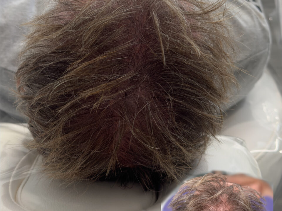 Scalp Micro SMP. Cosmetic and Medical Tattoo by Dasha. Permanent makeup and reconstructive tattoo, scalp micro-pigmentation in Christchurch, New Zealand