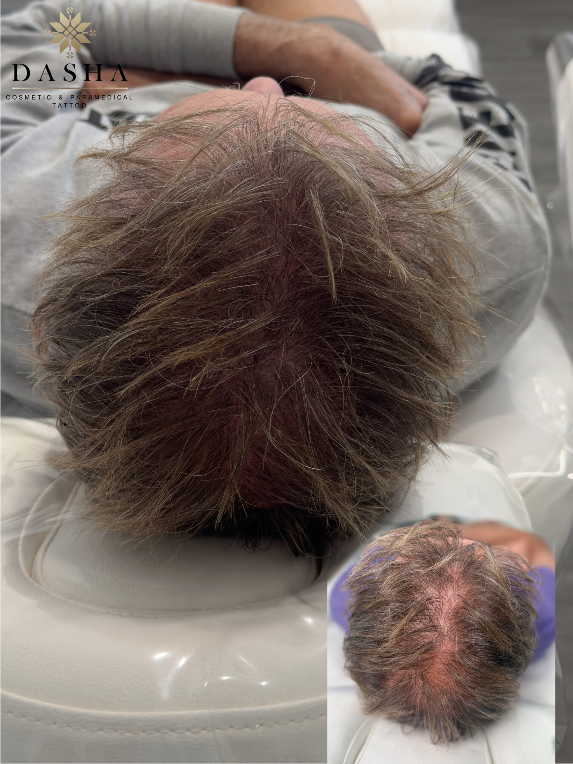 Scalp Micro SMP. Cosmetic and Medical Tattoo by Dasha. Permanent makeup and reconstructive tattoo, scalp micro-pigmentation in Christchurch, New Zealand