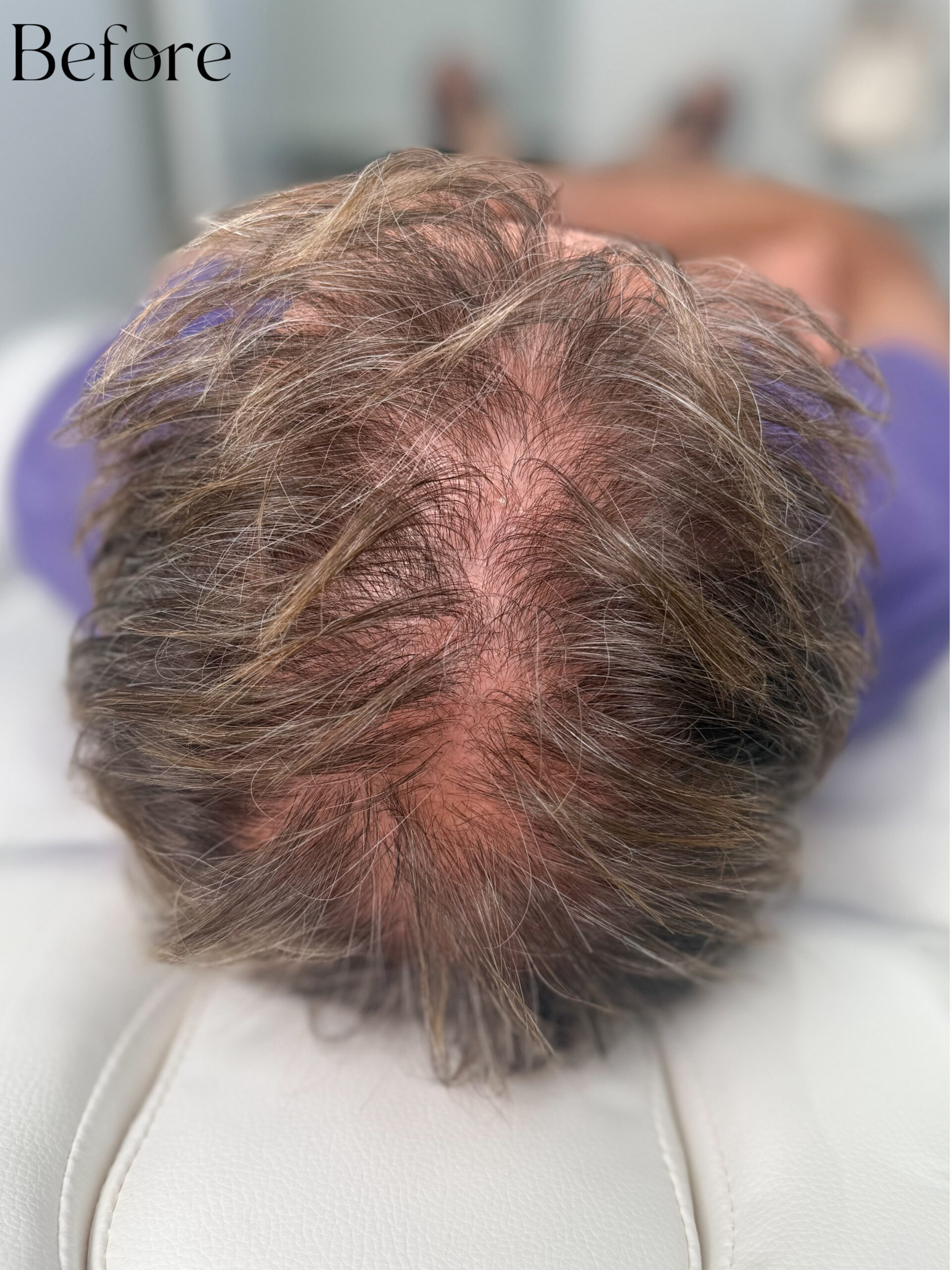 Scalp Micro SMP. Cosmetic and Medical Tattoo by Dasha. Permanent makeup and reconstructive tattoo, scalp micro-pigmentation in Christchurch, New Zealand
