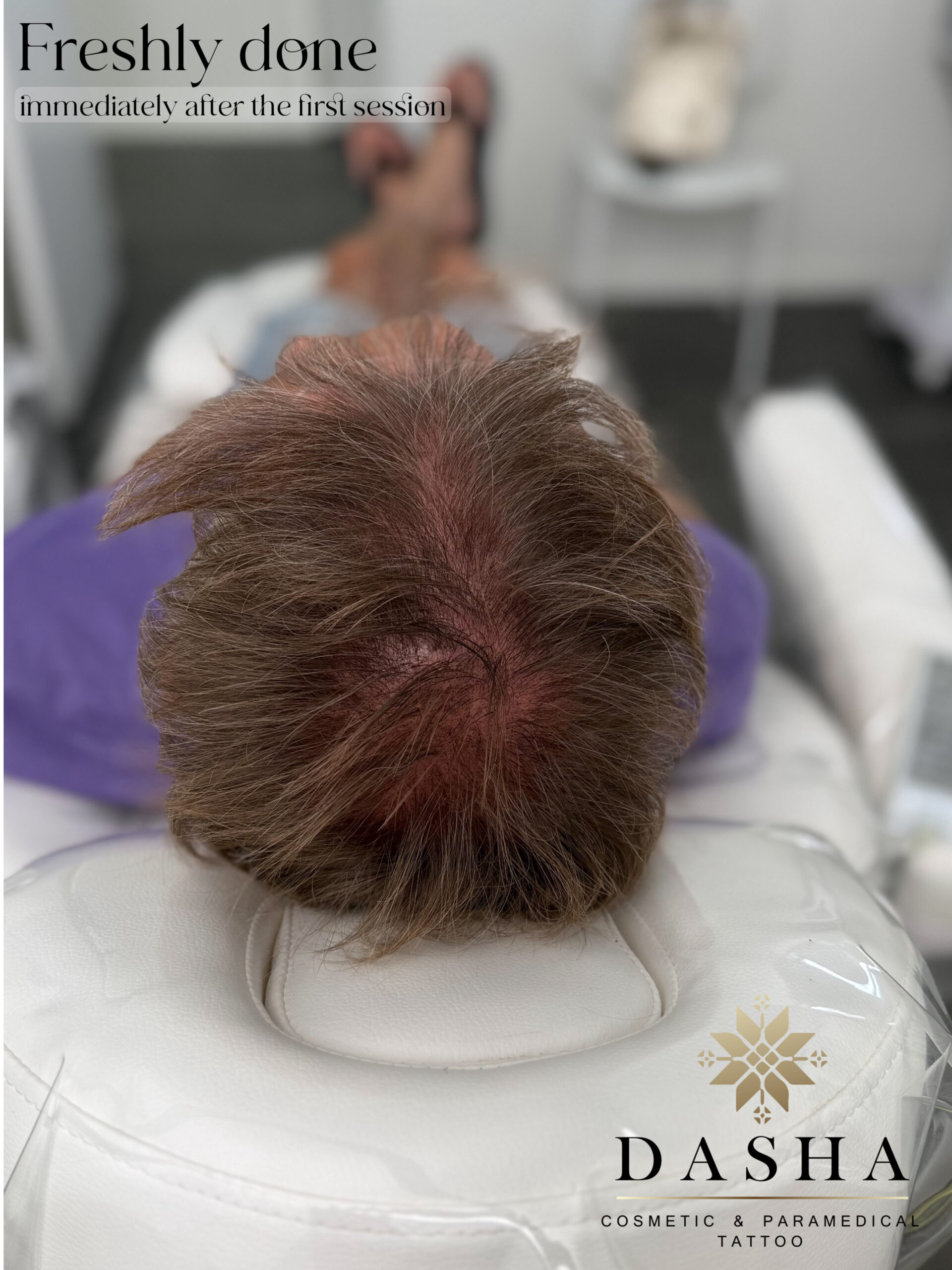 Scalp Micro SMP. Cosmetic and Medical Tattoo by Dasha. Permanent makeup and reconstructive tattoo, scalp micro-pigmentation in Christchurch, New Zealand