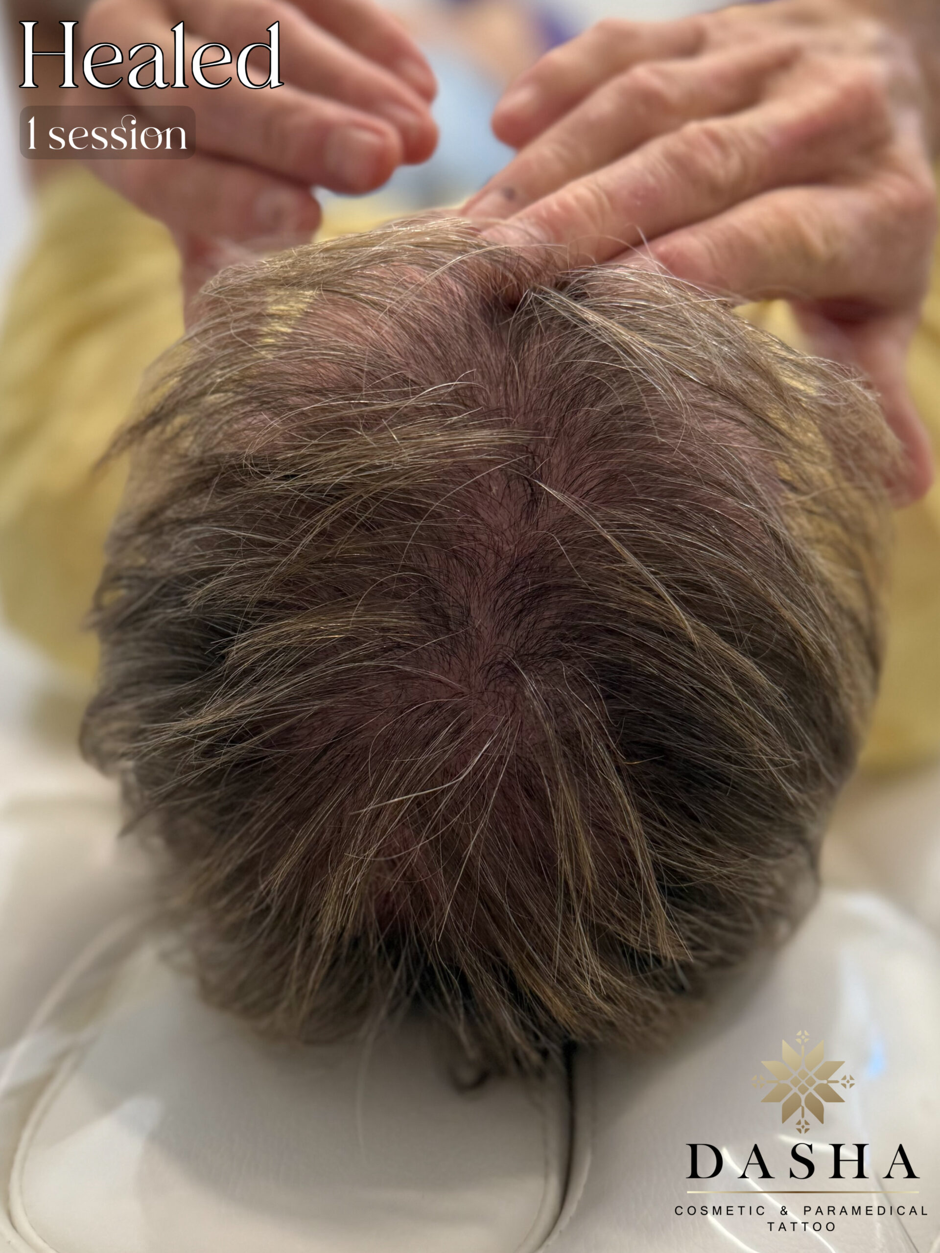 Scalp Micro SMP. Cosmetic and Medical Tattoo by Dasha. Permanent makeup and reconstructive tattoo, scalp micro-pigmentation in Christchurch, New Zealand